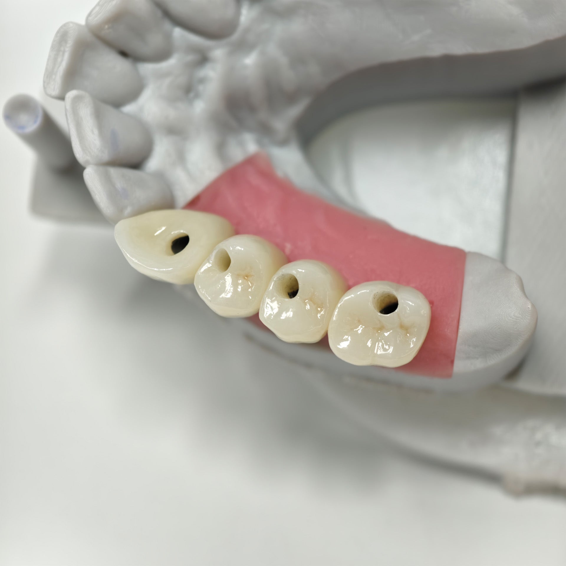 Zirconia Crowns With Screw Retained