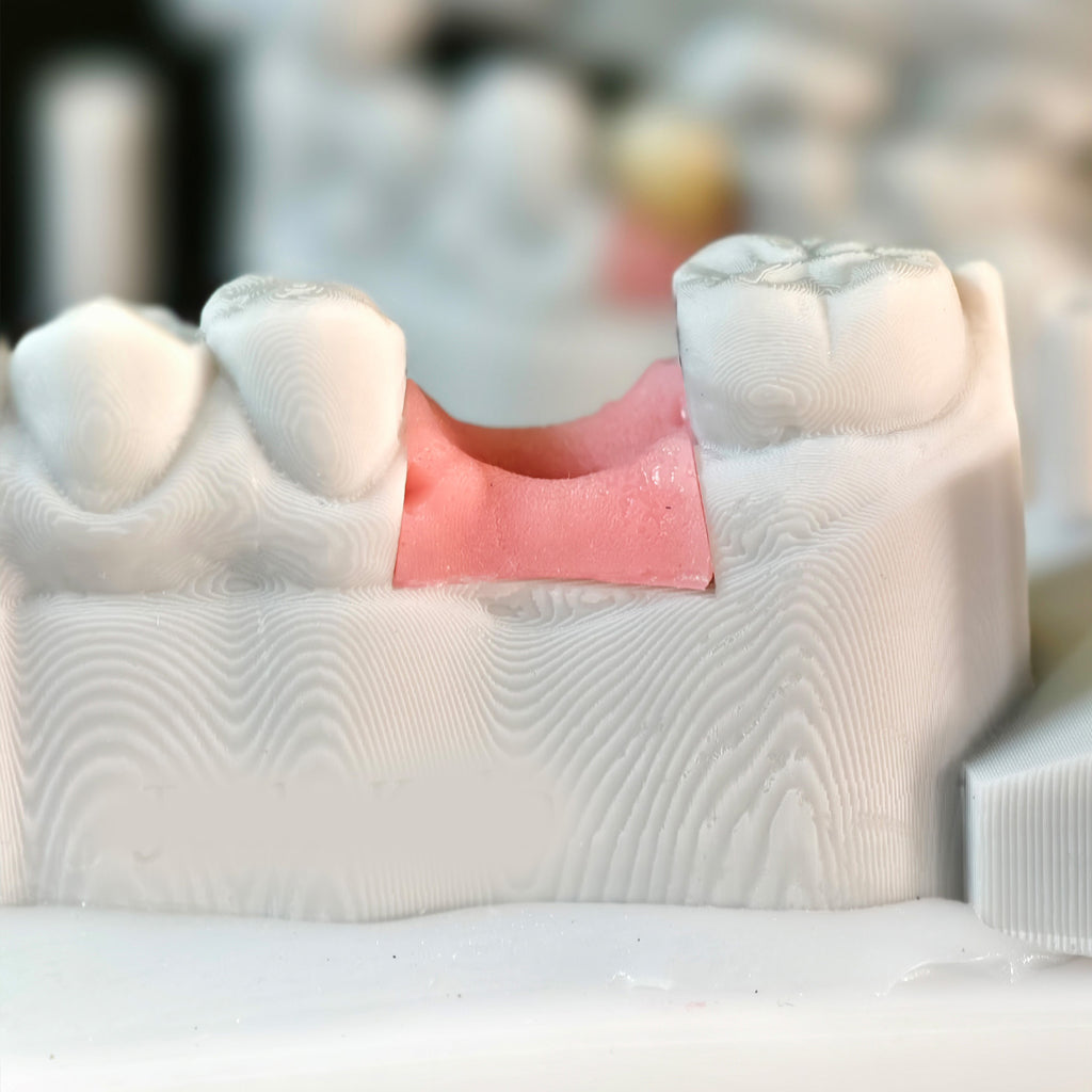 Zirconia Crowns With Screw Retained