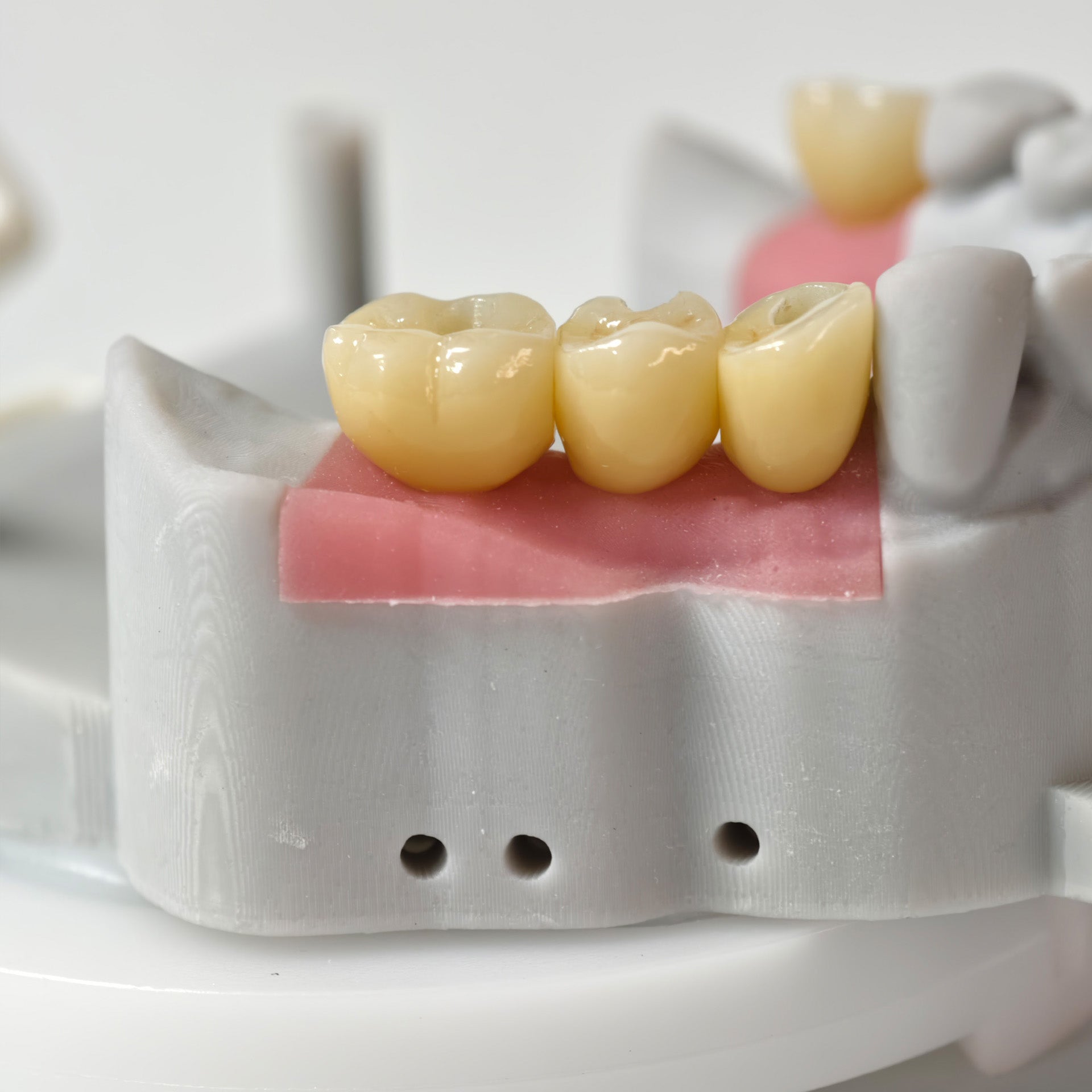 Zirconia Crowns With Screw Retained