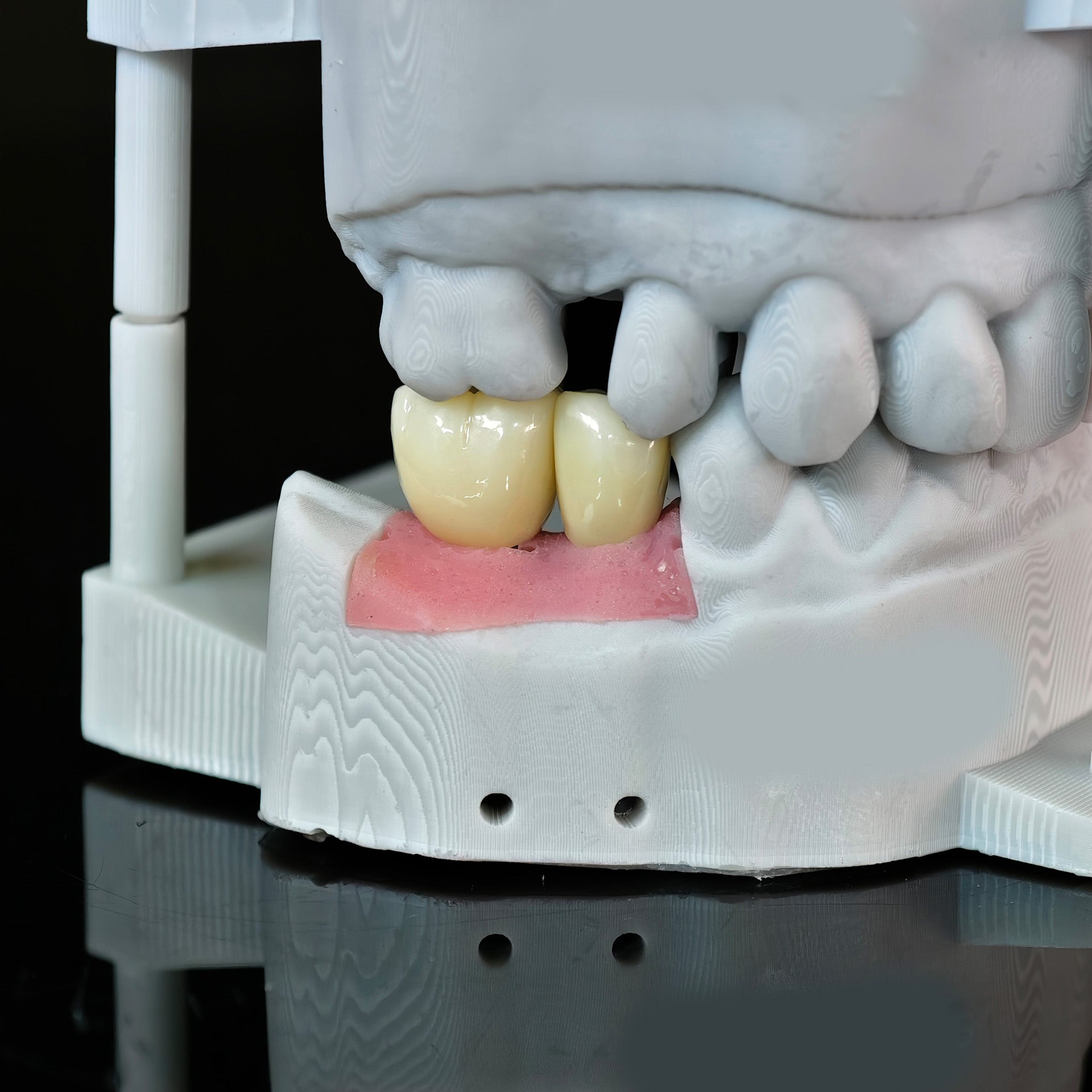 Zirconia Crowns With Screw Retained