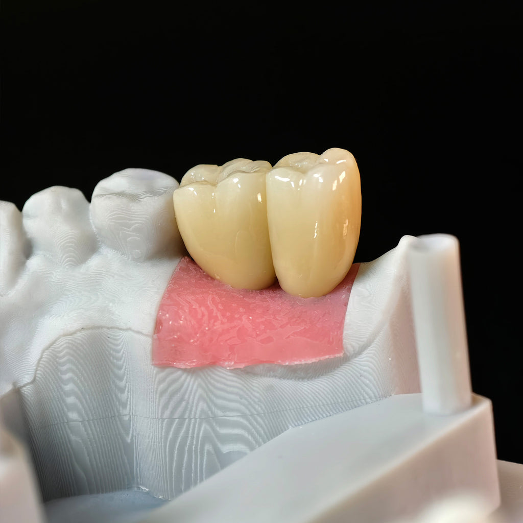 Zirconia Crowns With Screw Retained