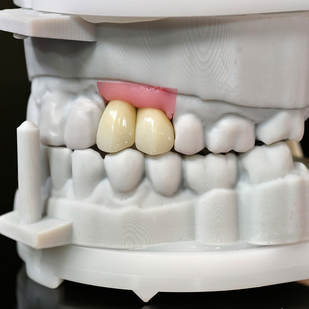 Zirconia Crowns With Screw Retained