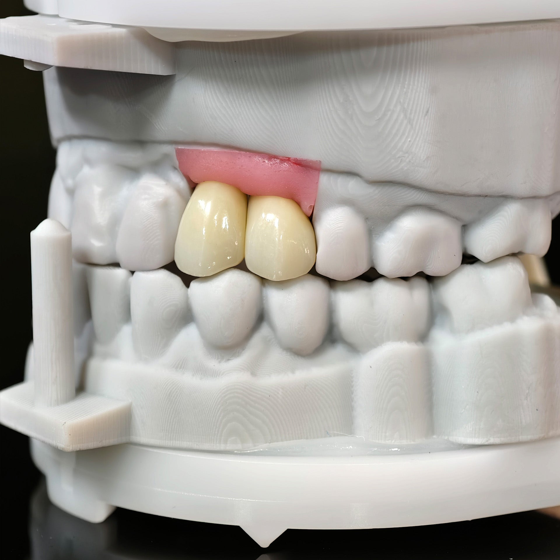 Zirconia Crowns With Screw Retained