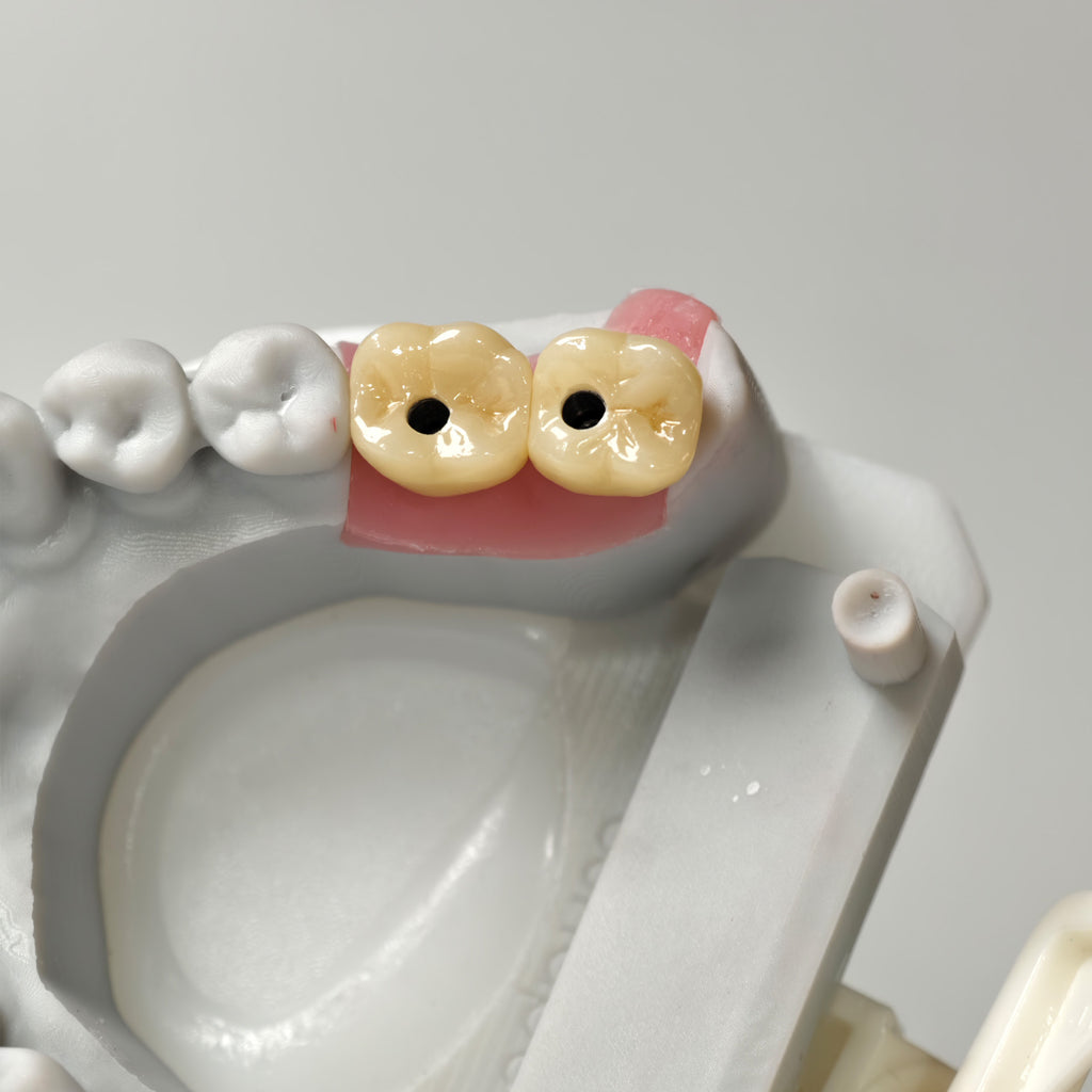 Zirconia Crowns With Screw Retained