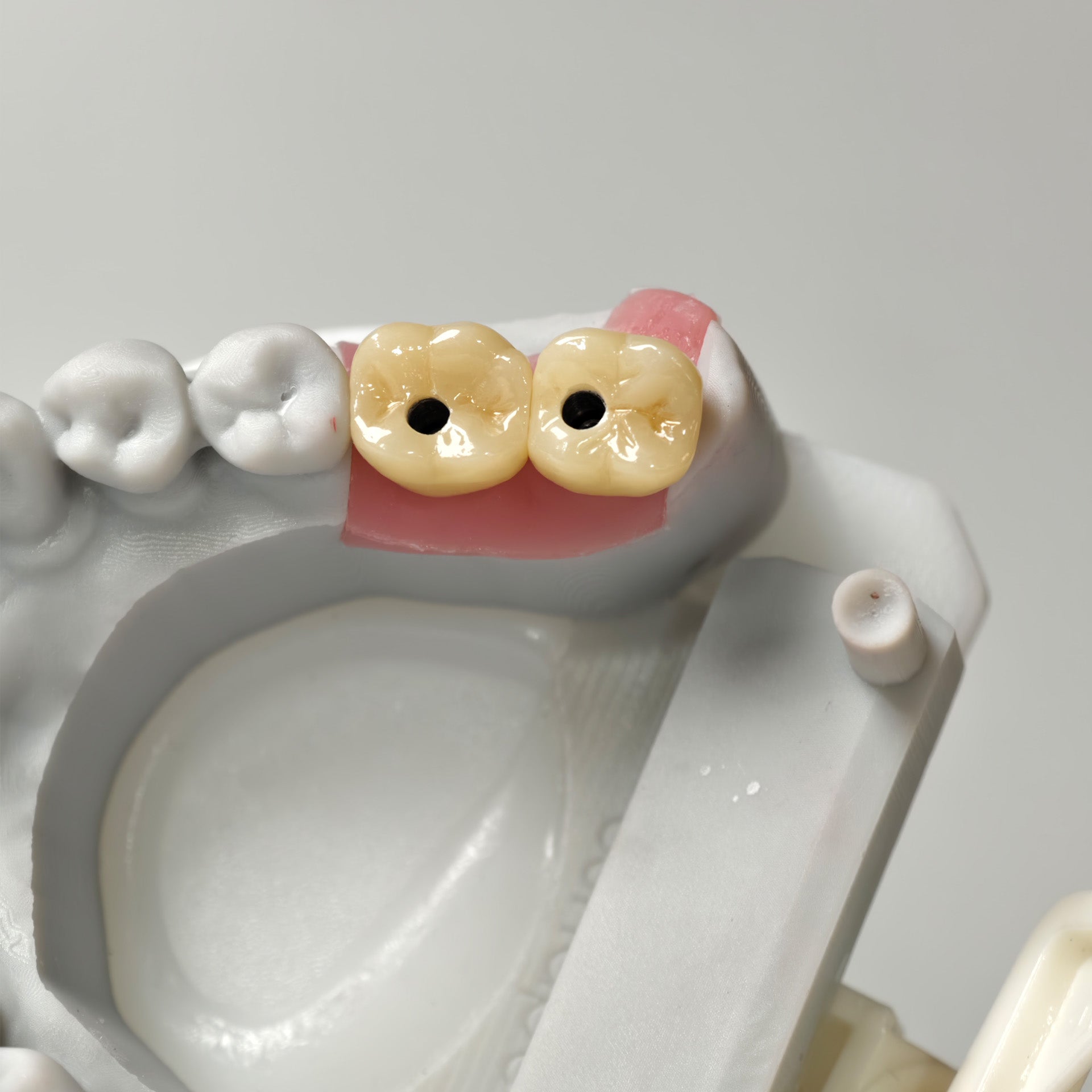 Zirconia Crowns With Screw Retained