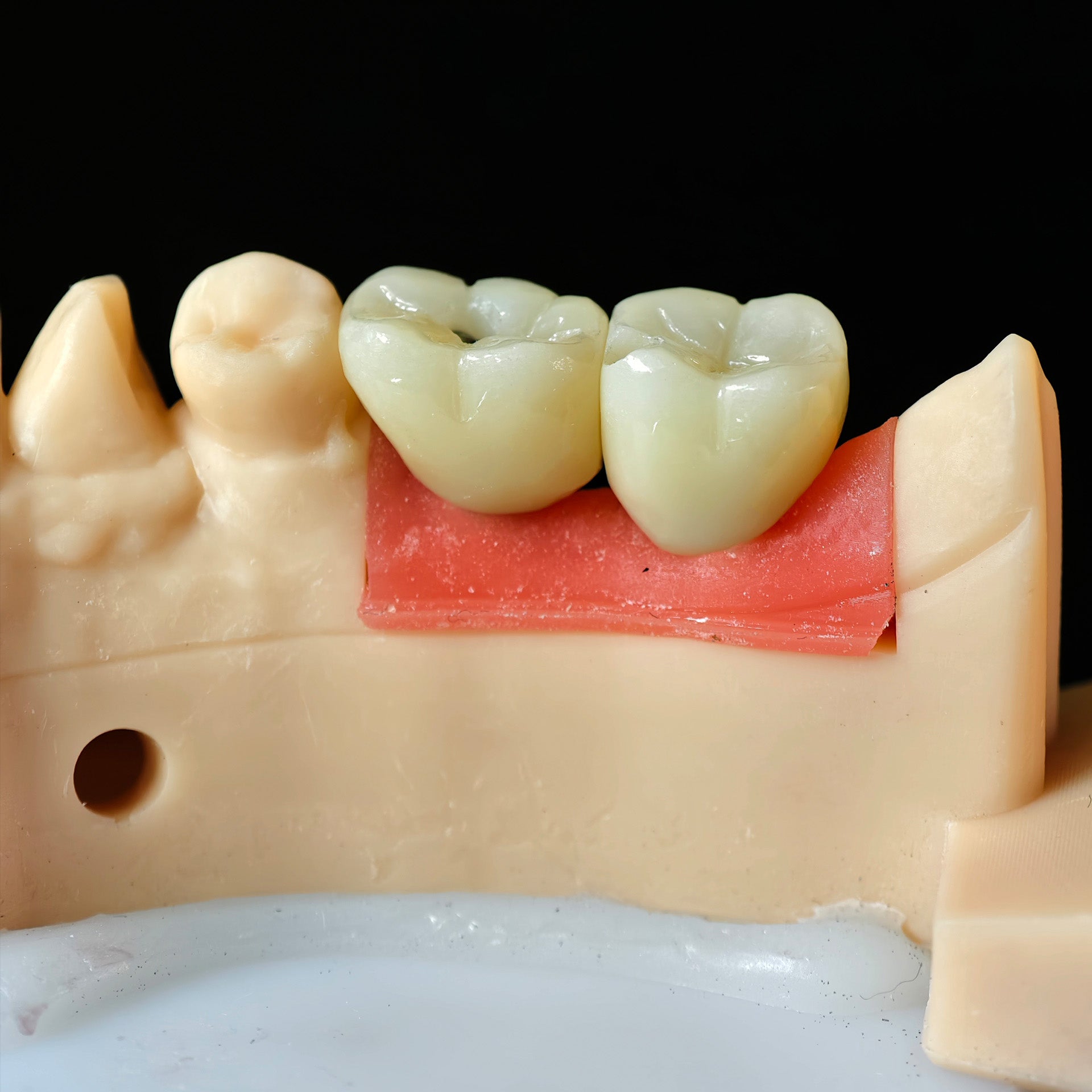 Zirconia Crowns With Screw Retained