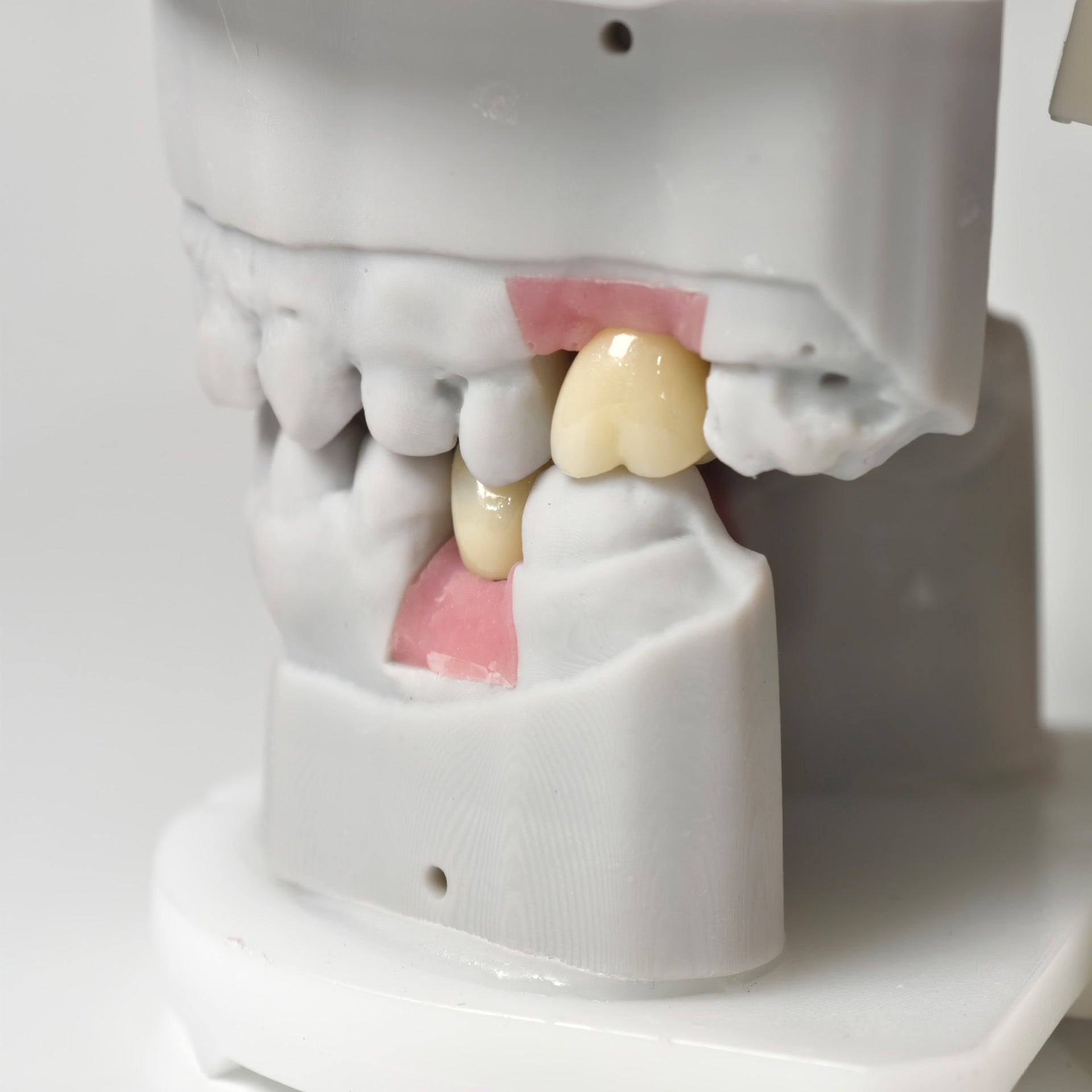 Zirconia Crowns With Screw Retained