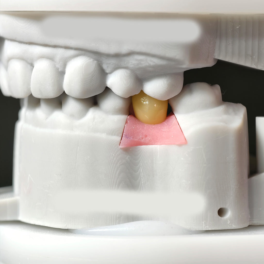 Zirconia Crowns With Screw Retained