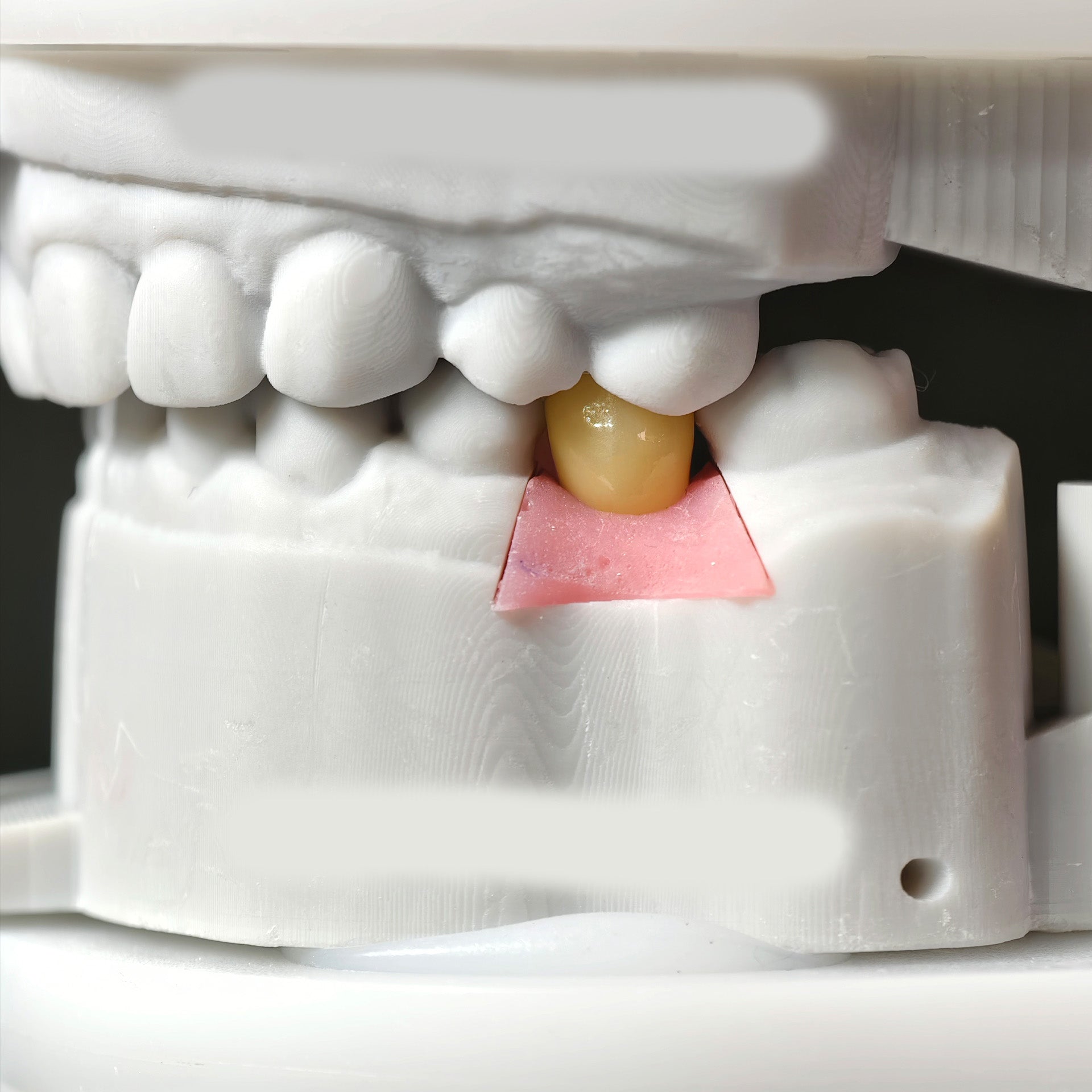 Zirconia Crowns With Screw Retained