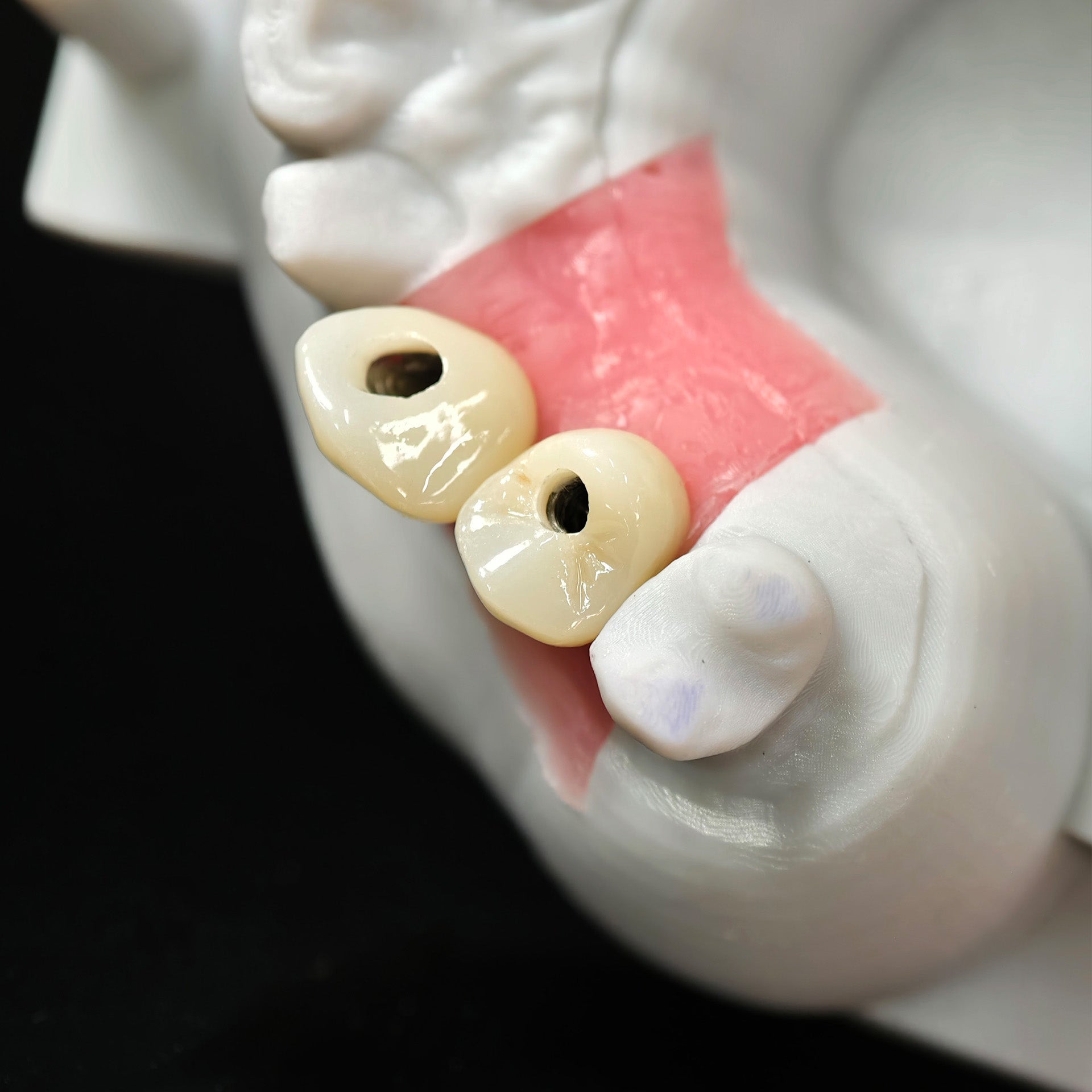 Zirconia Crowns With Screw Retained