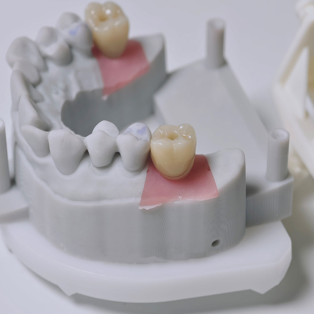 Zirconia Crowns With Screw Retained