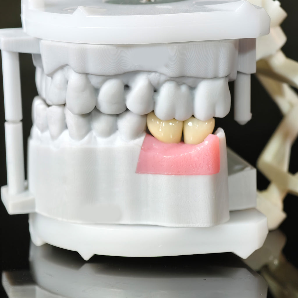 Zirconia Crowns With Screw Retained