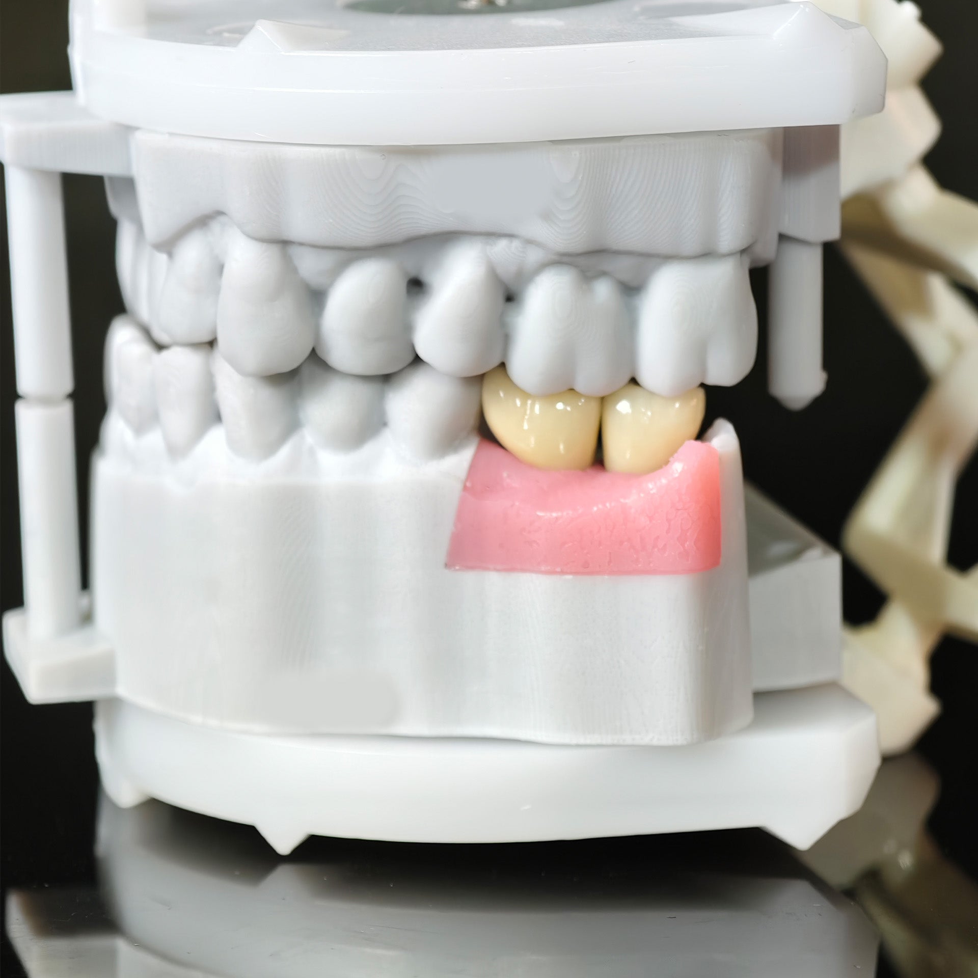 Zirconia Crowns With Screw Retained