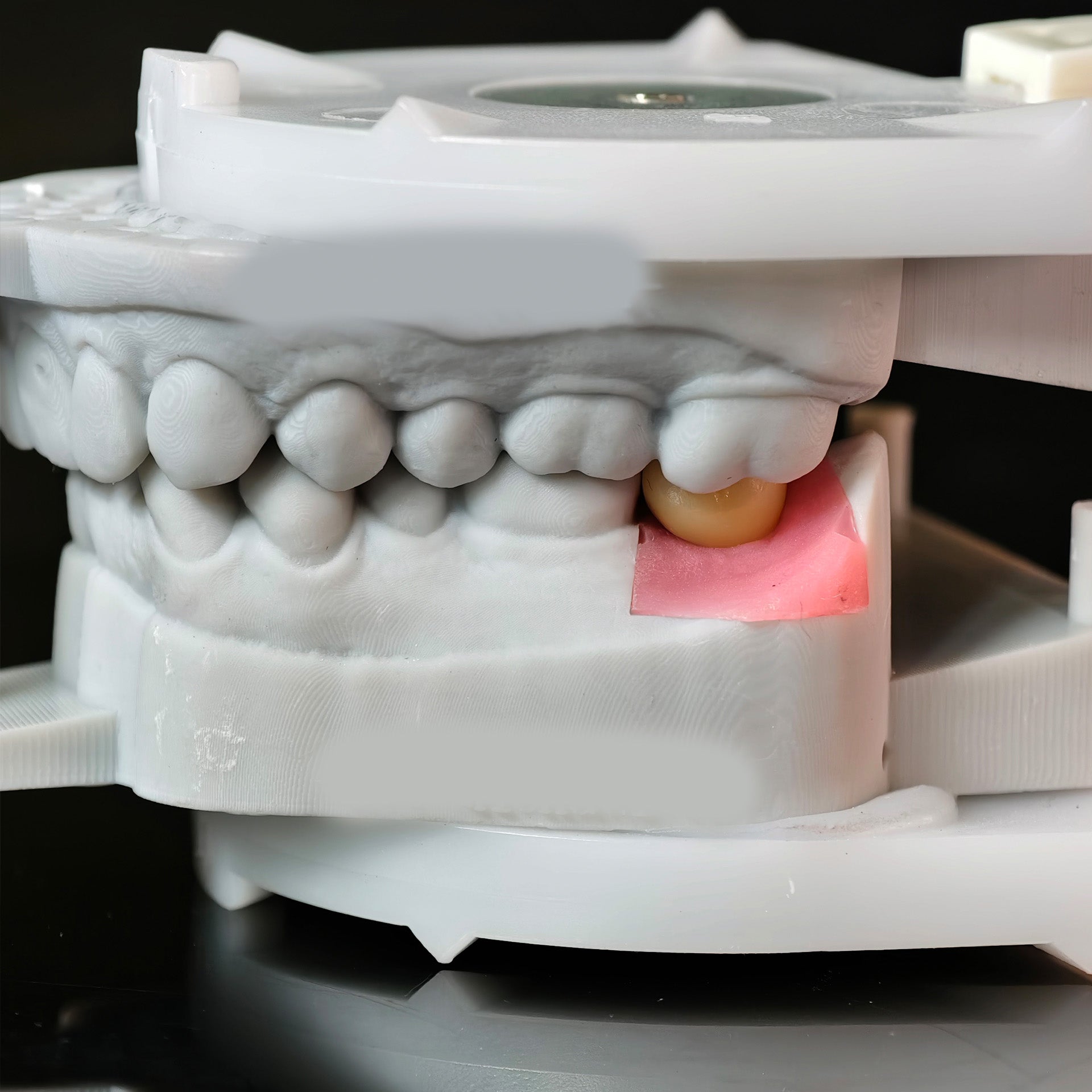 Zirconia Crowns With Screw Retained