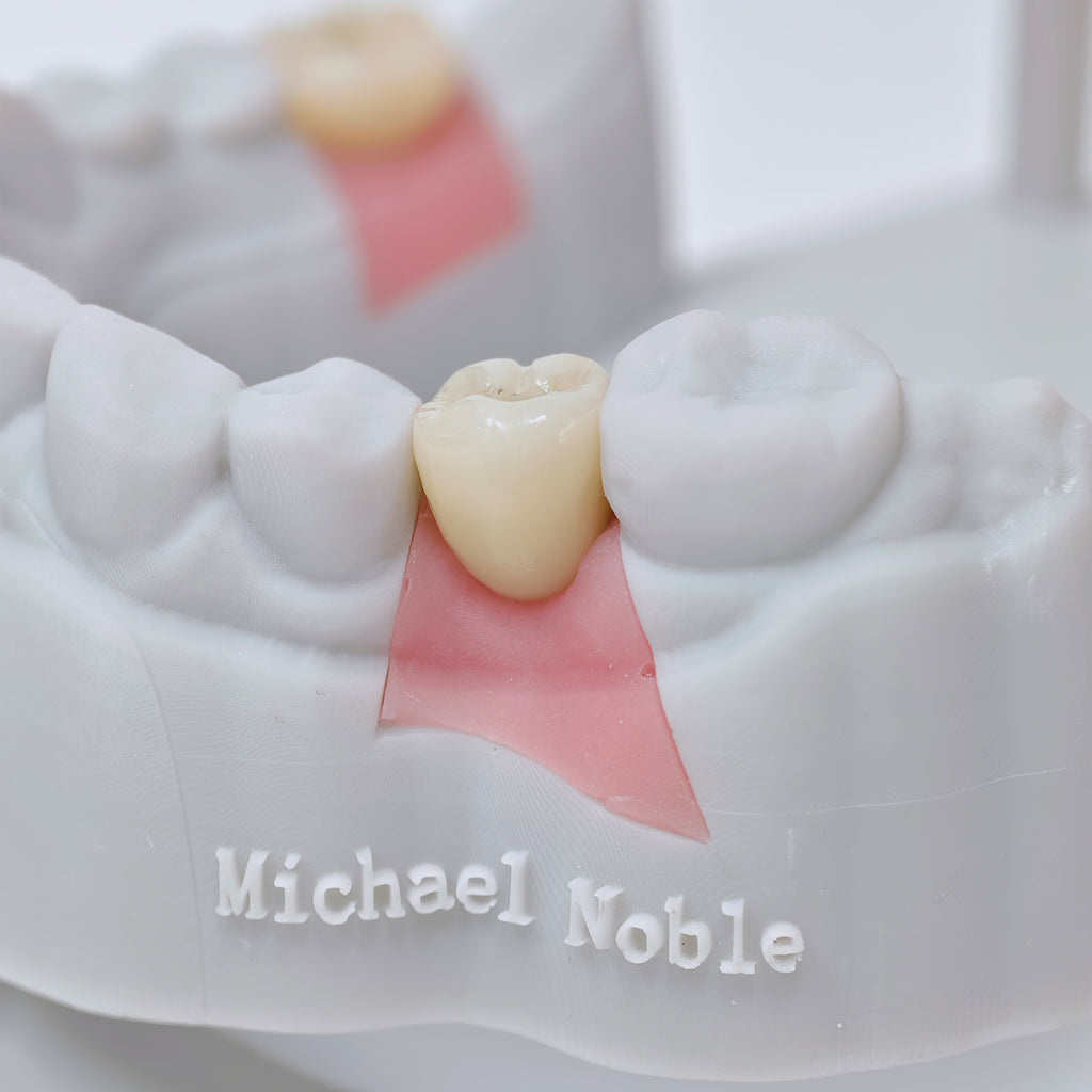 Zirconia Crowns With Screw Retained