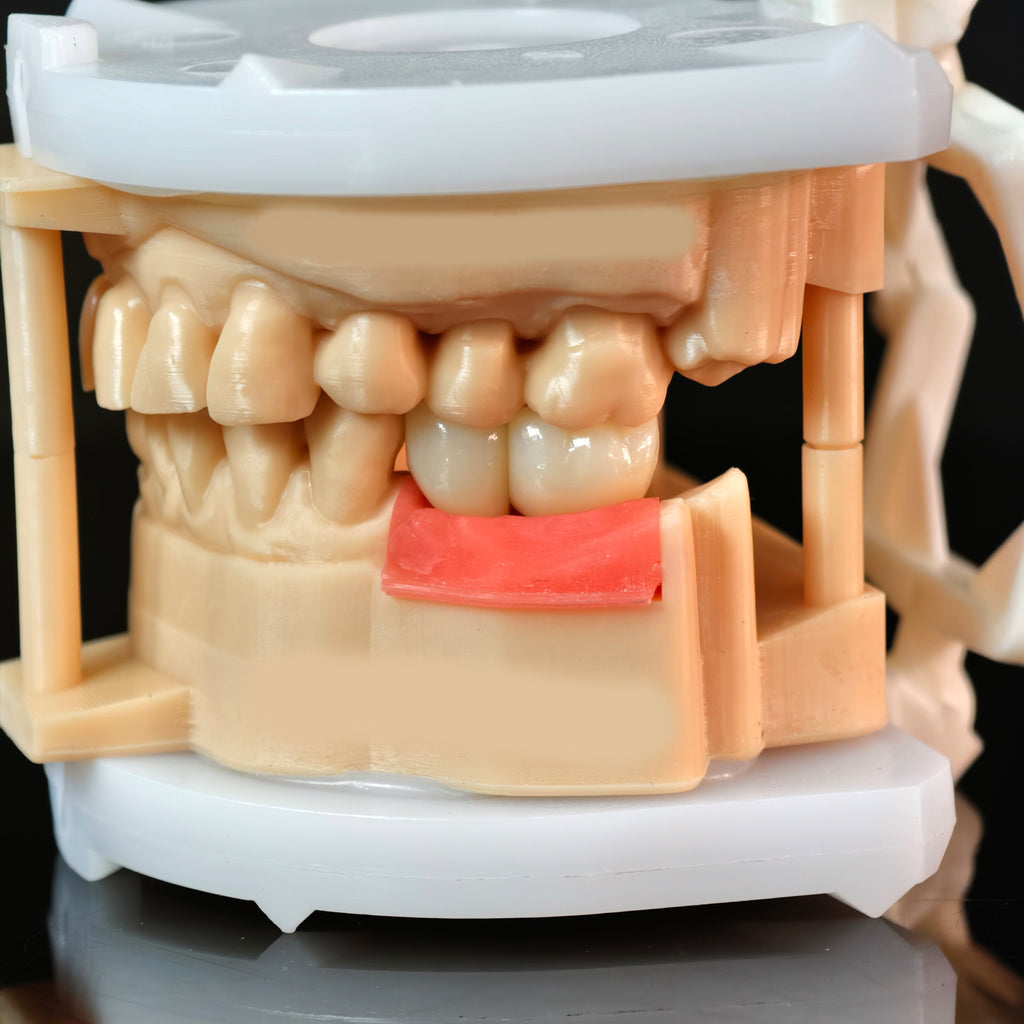 Zirconia Crowns With Screw Retained