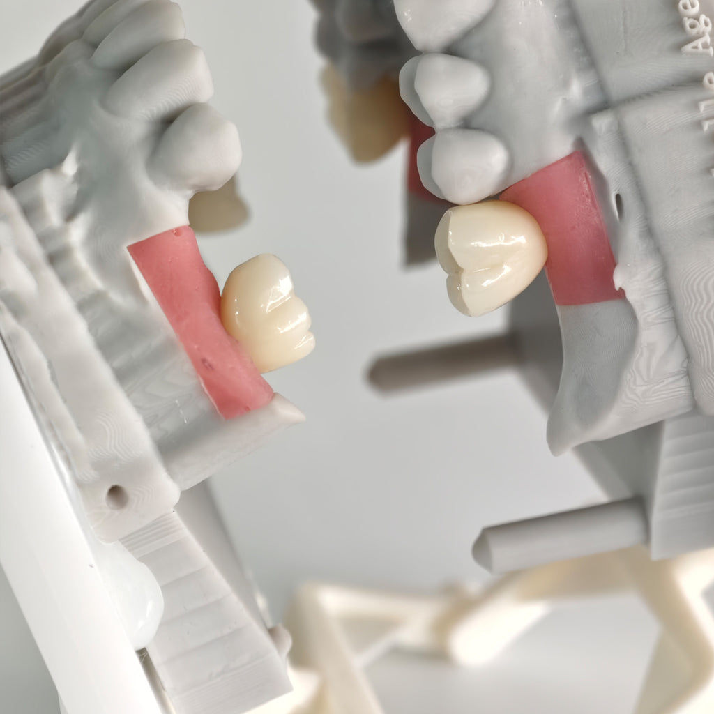 Zirconia Crowns With Screw Retained