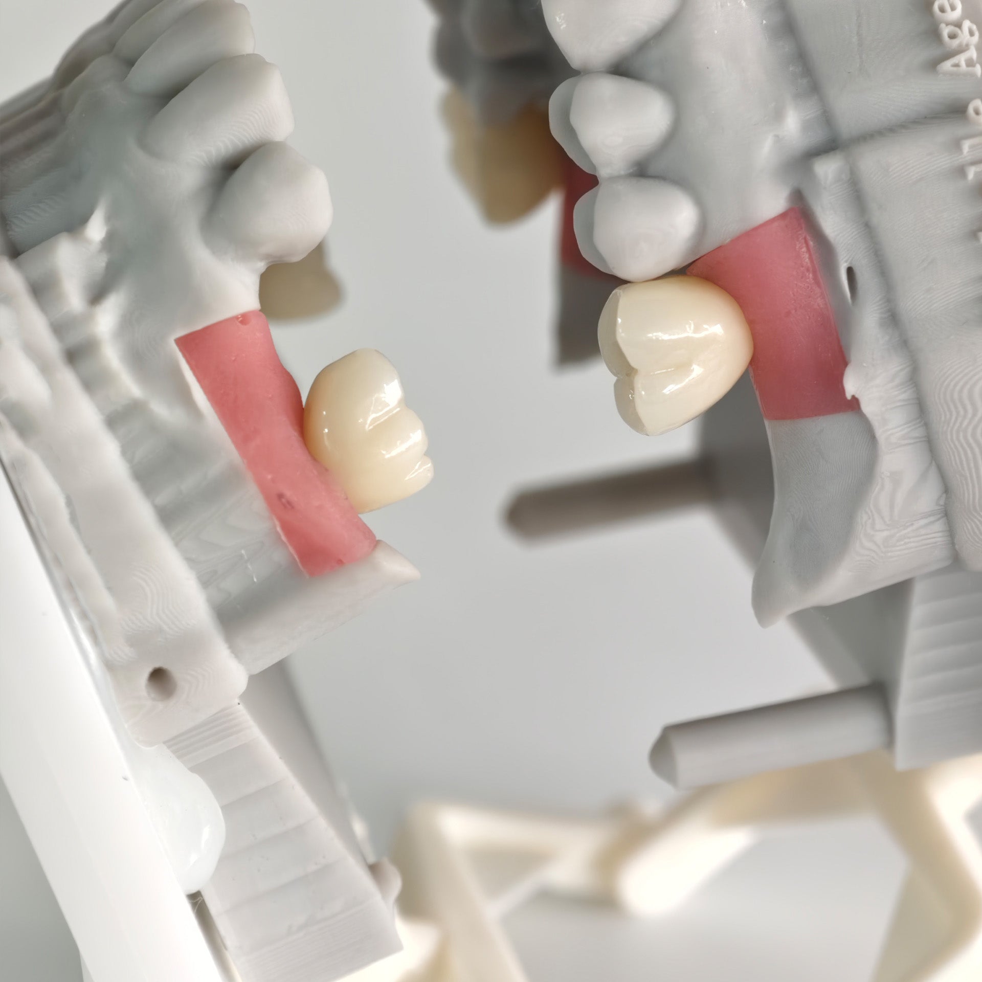 Zirconia Crowns With Screw Retained