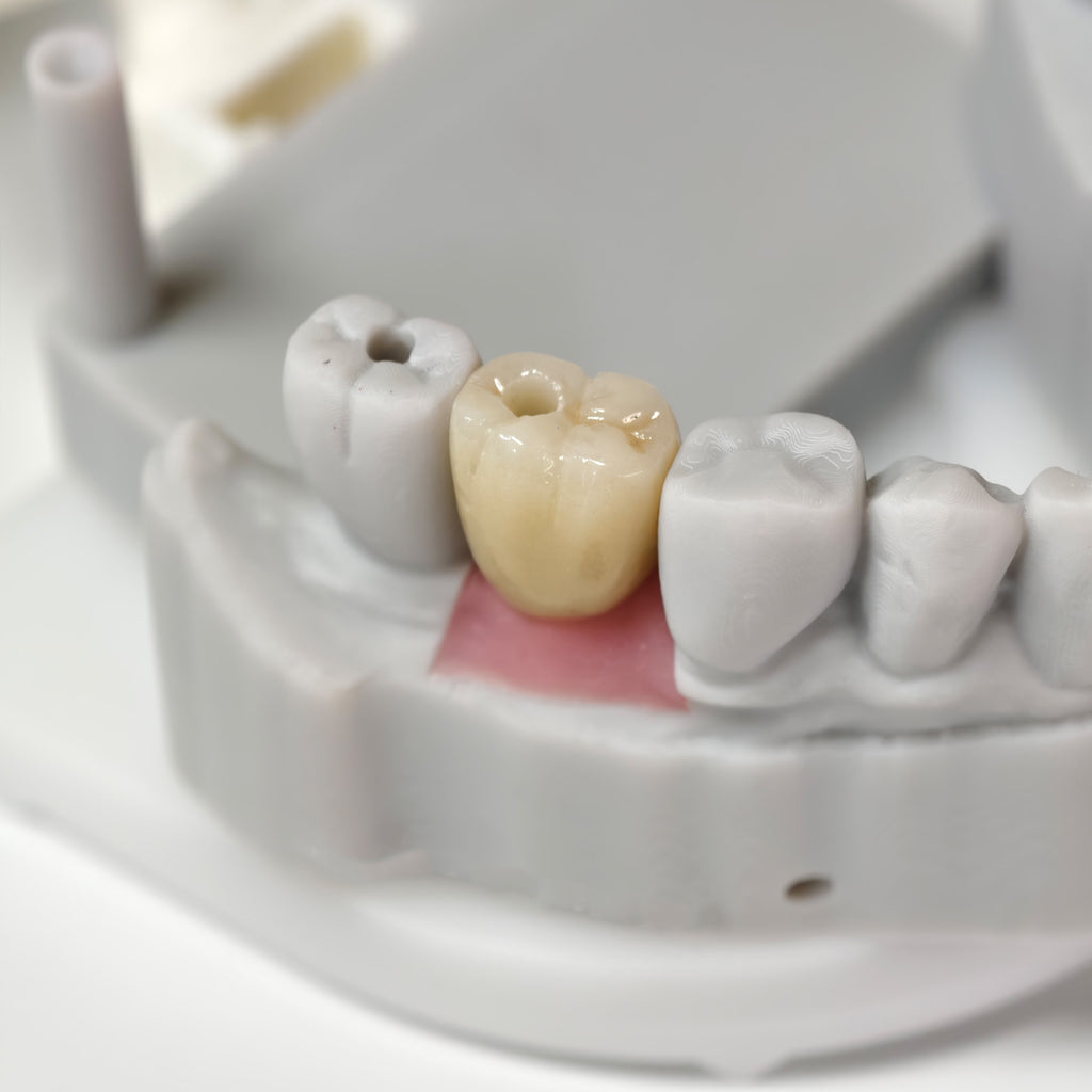 Zirconia Crowns With Screw Retained