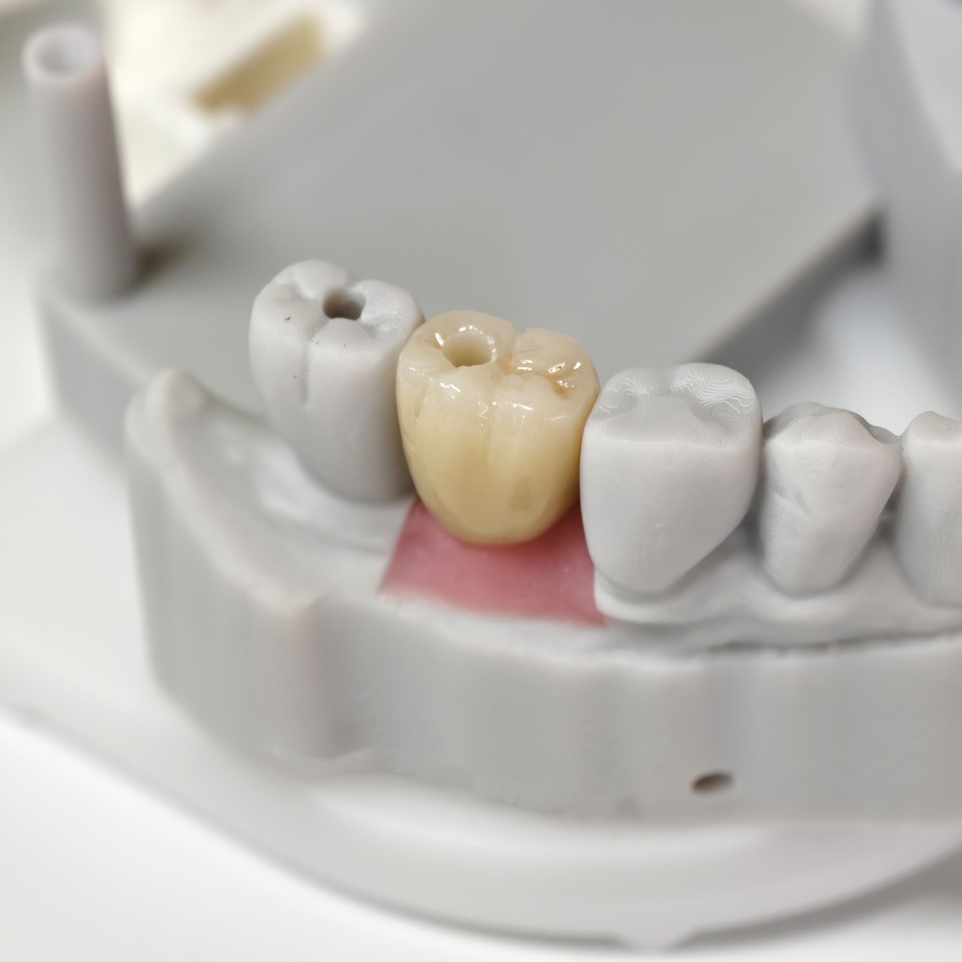 Zirconia Crowns With Screw Retained