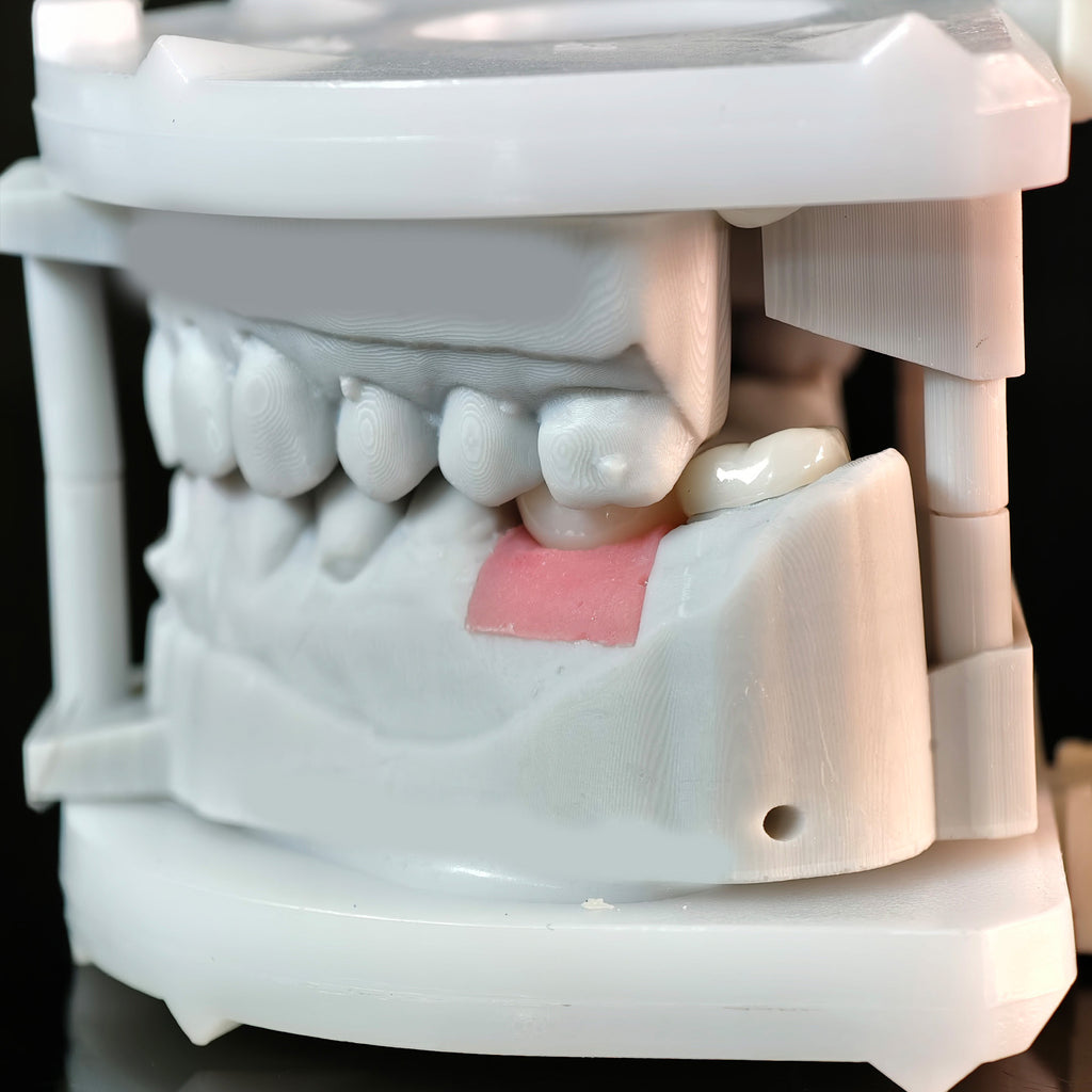 Zirconia Crowns With Screw Retained And Cement Retained