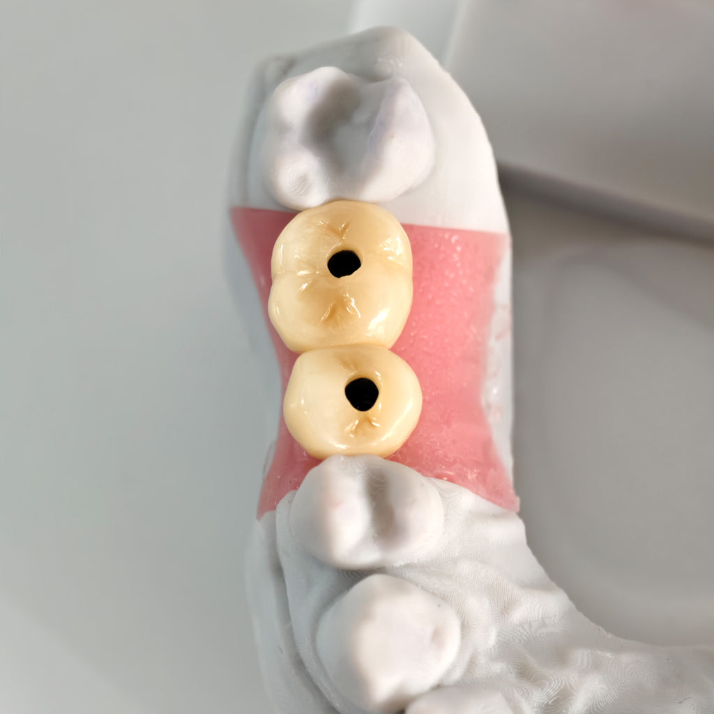 Zirconia Crowns With Screw Retained And Gold-Plated Custom Abutment