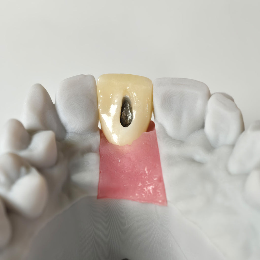 Zirconia Crown With Gold-Plated Abutment