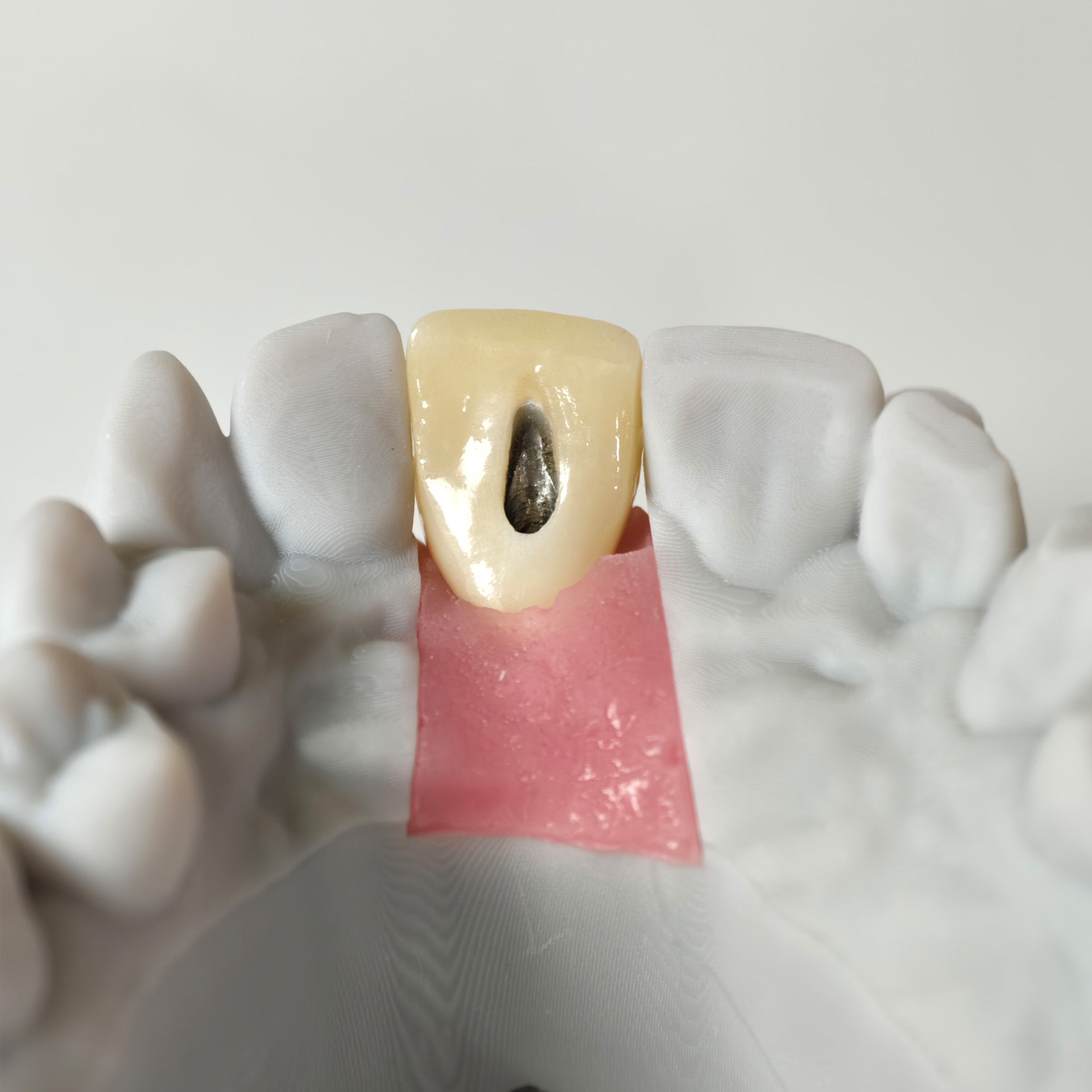 Zirconia Crown With Gold-Plated Abutment