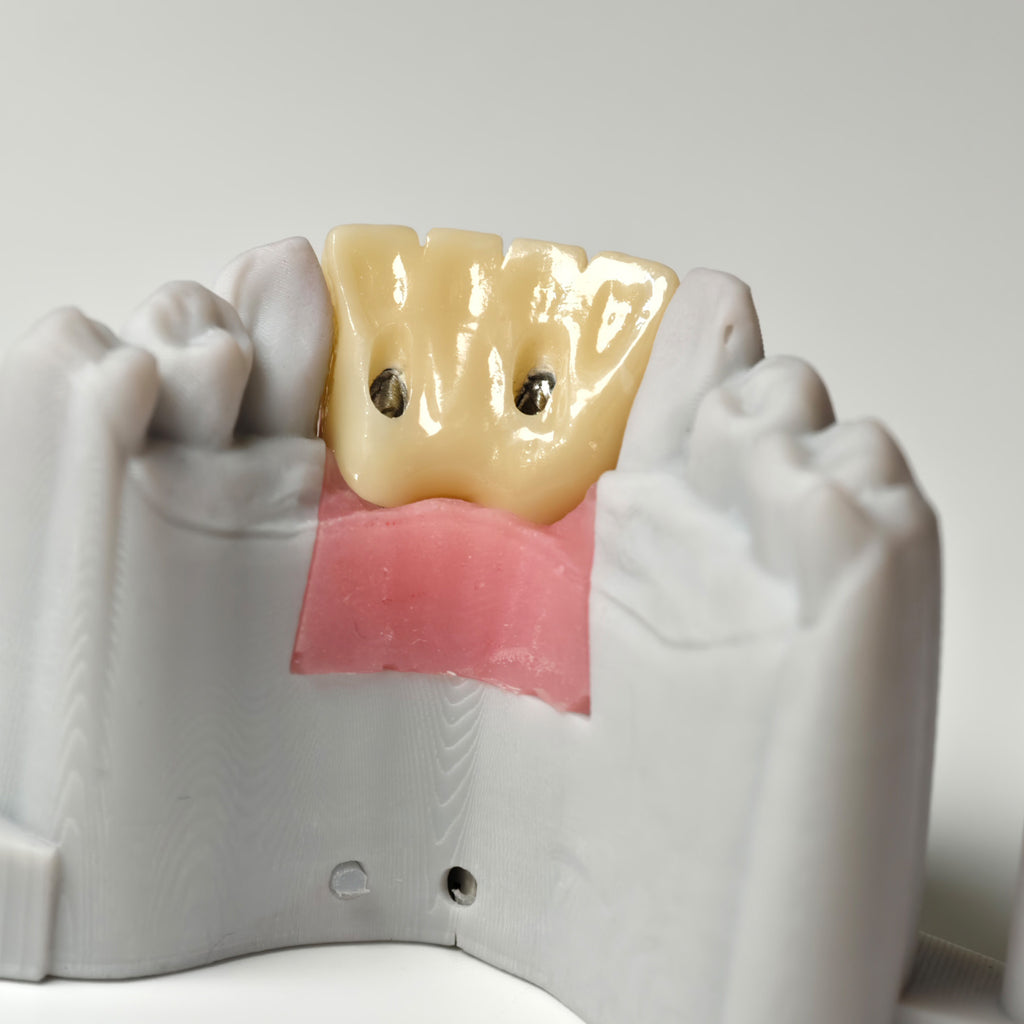 Zirconia Crown With Gold-Plated Abutment