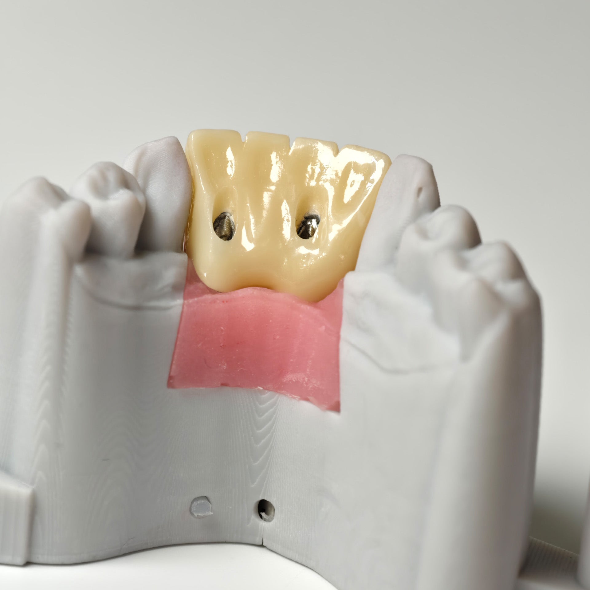 Zirconia Crown With Gold-Plated Abutment