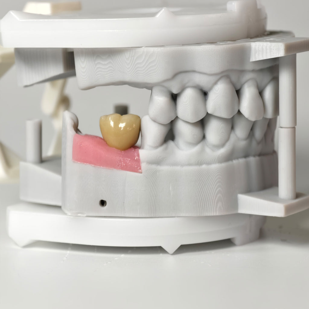 Zirconia Crown With Gold-Plated Abutment