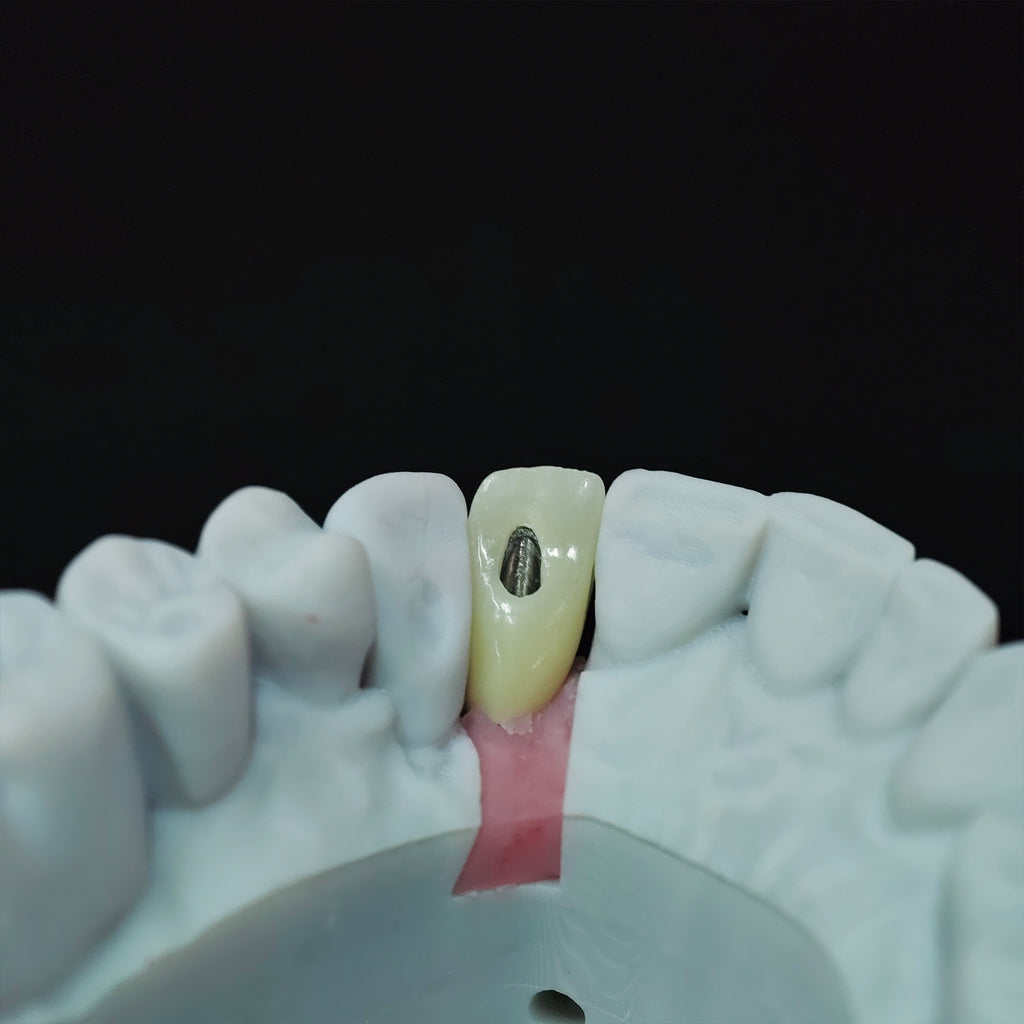Zirconia Crown With Screw Retained