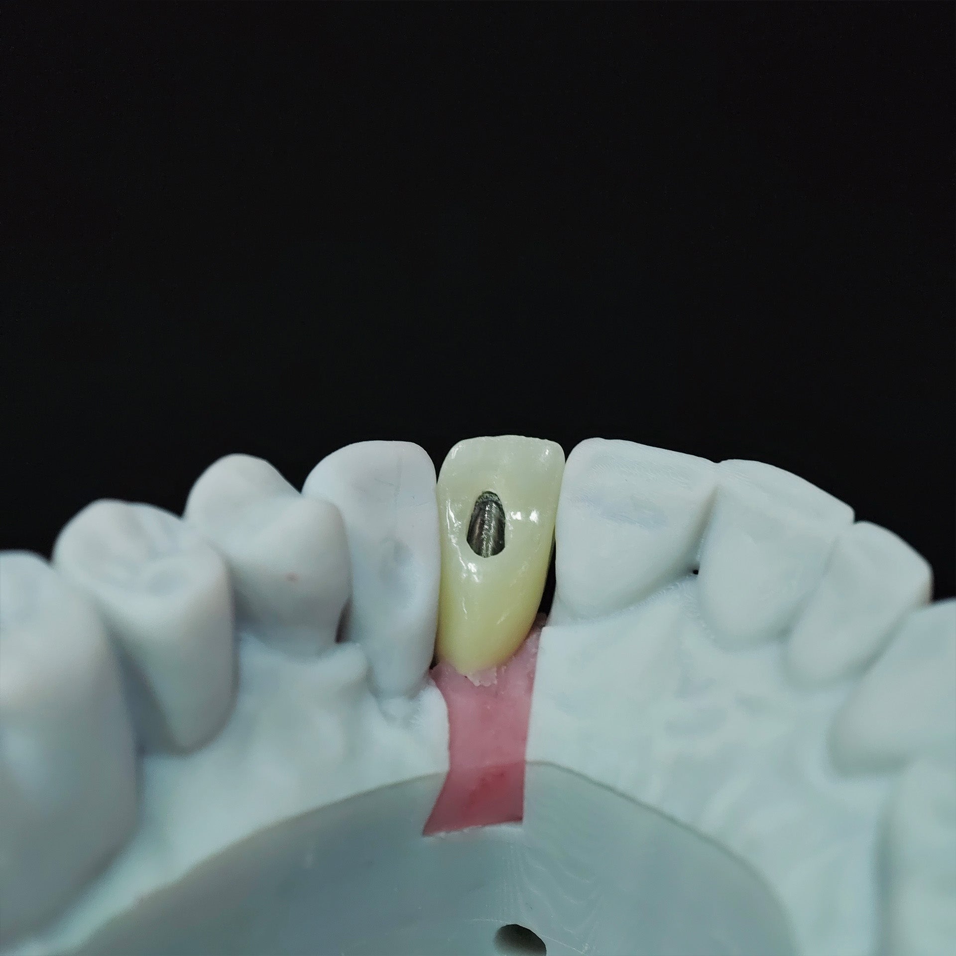 Zirconia Crown With Screw Retained