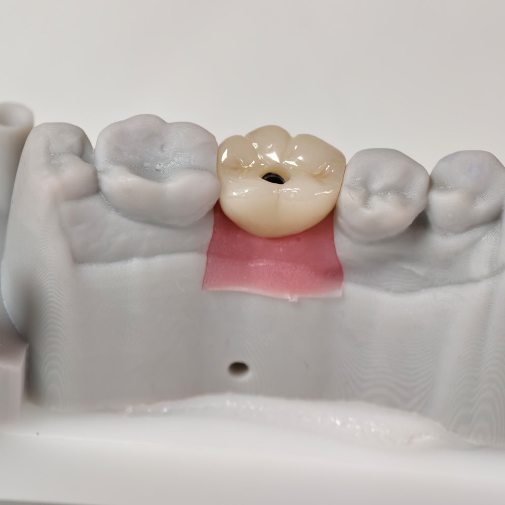 Zirconia Crown With Screw Retained