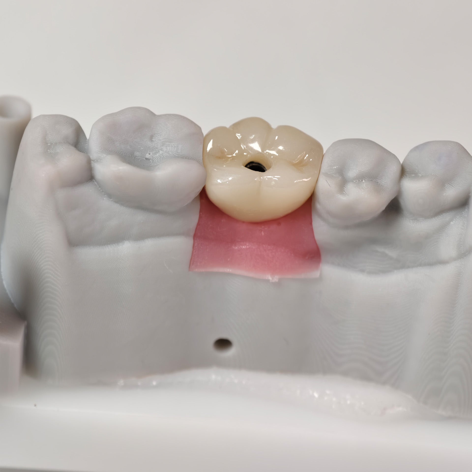 Zirconia Crown With Screw Retained