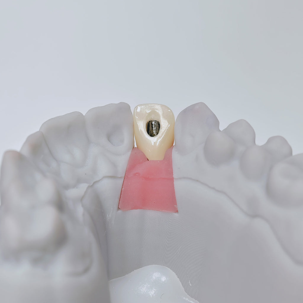 Zirconia Crown With Screw Retained