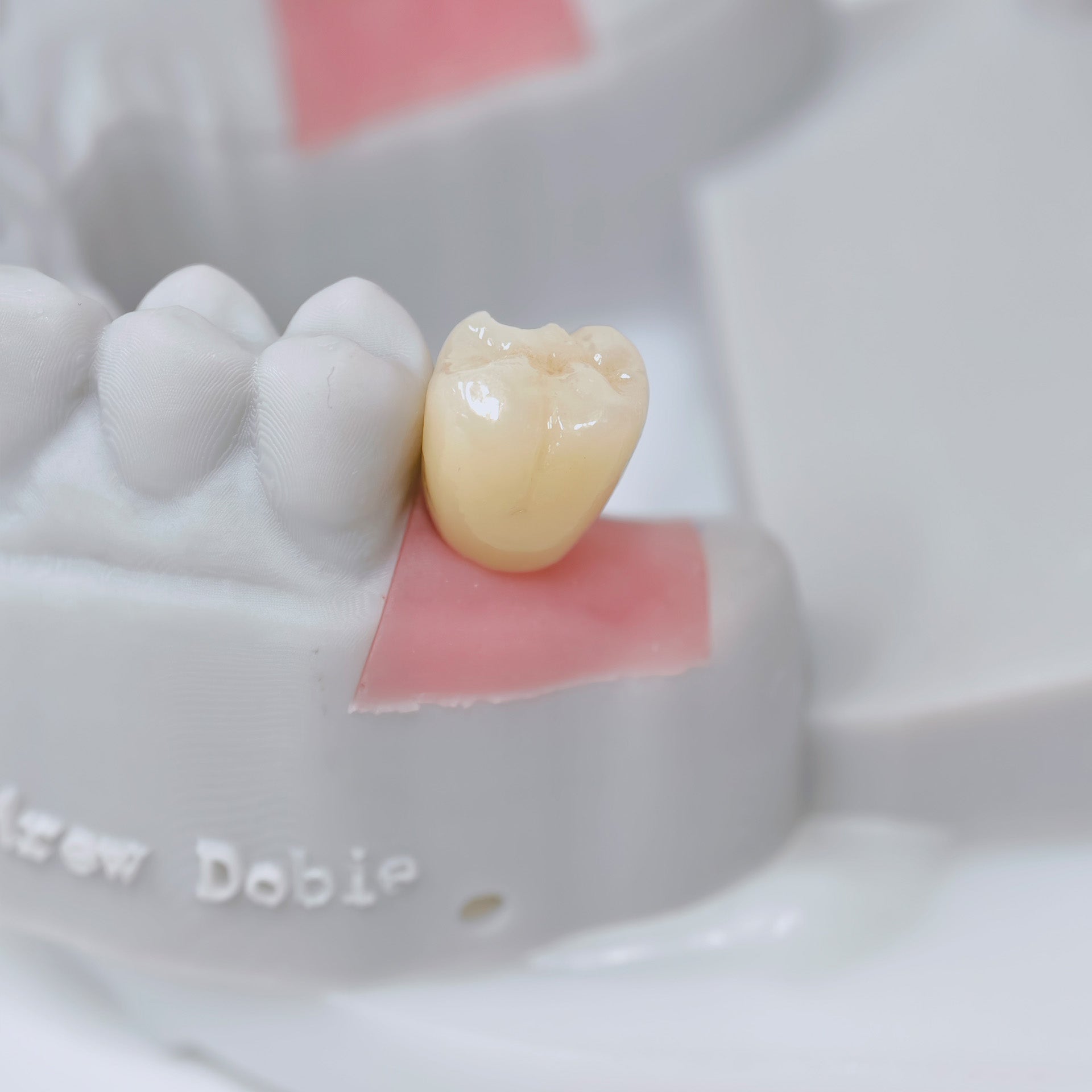 Zirconia Crown With Screw Retained