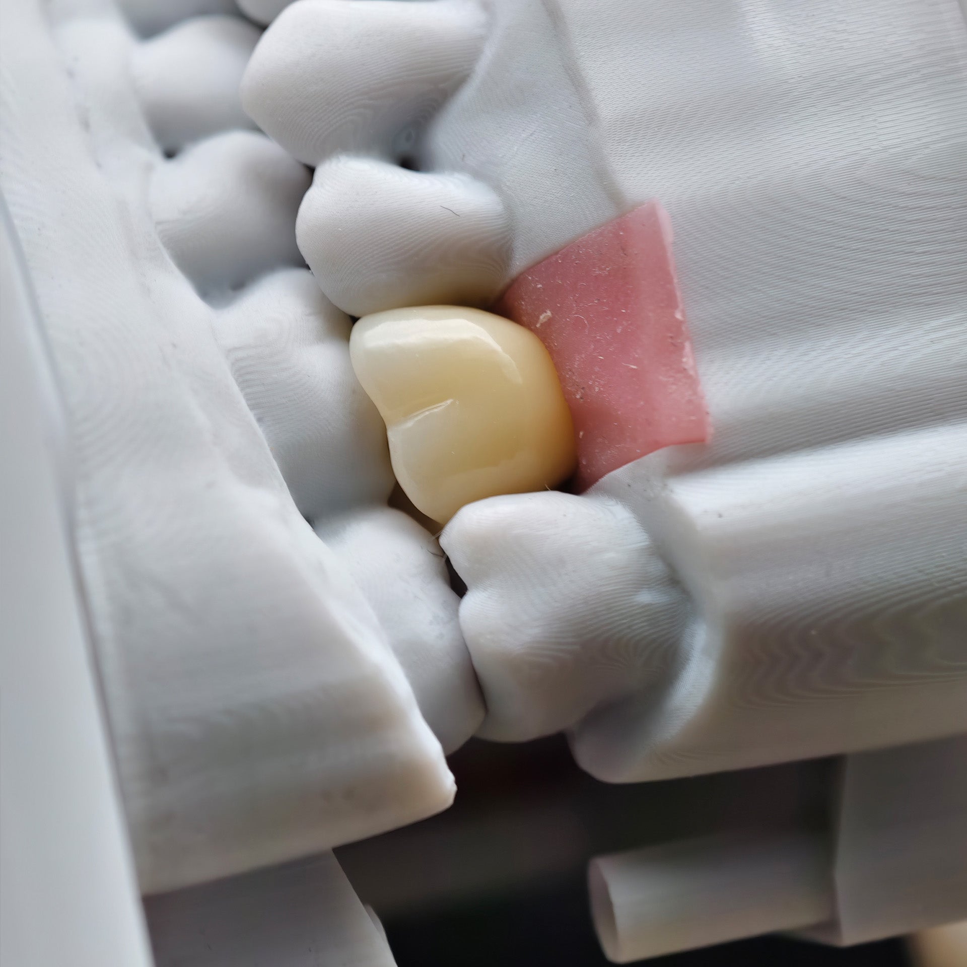 Zirconia Crown With Screw Retained