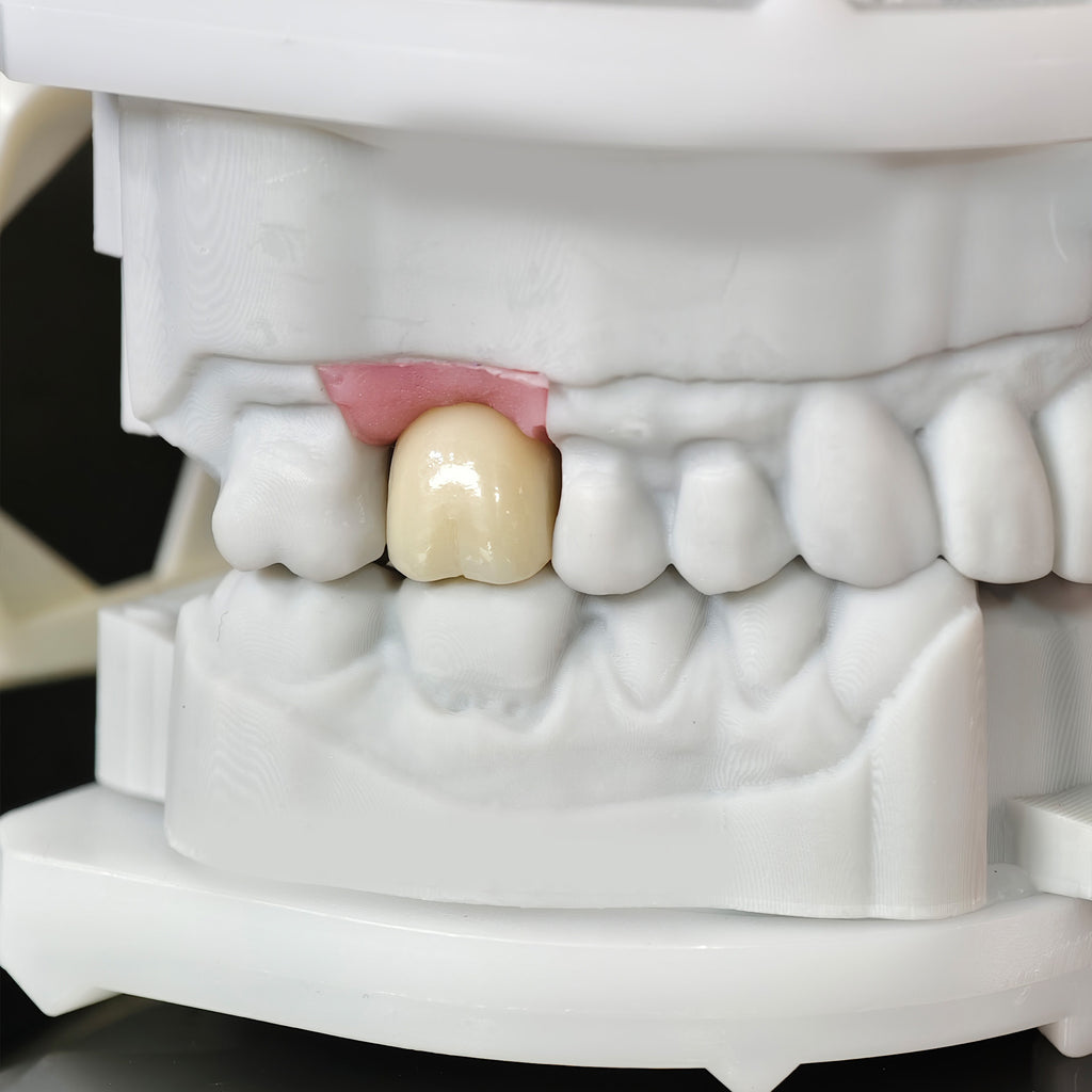 Zirconia Crown With Screw Retained