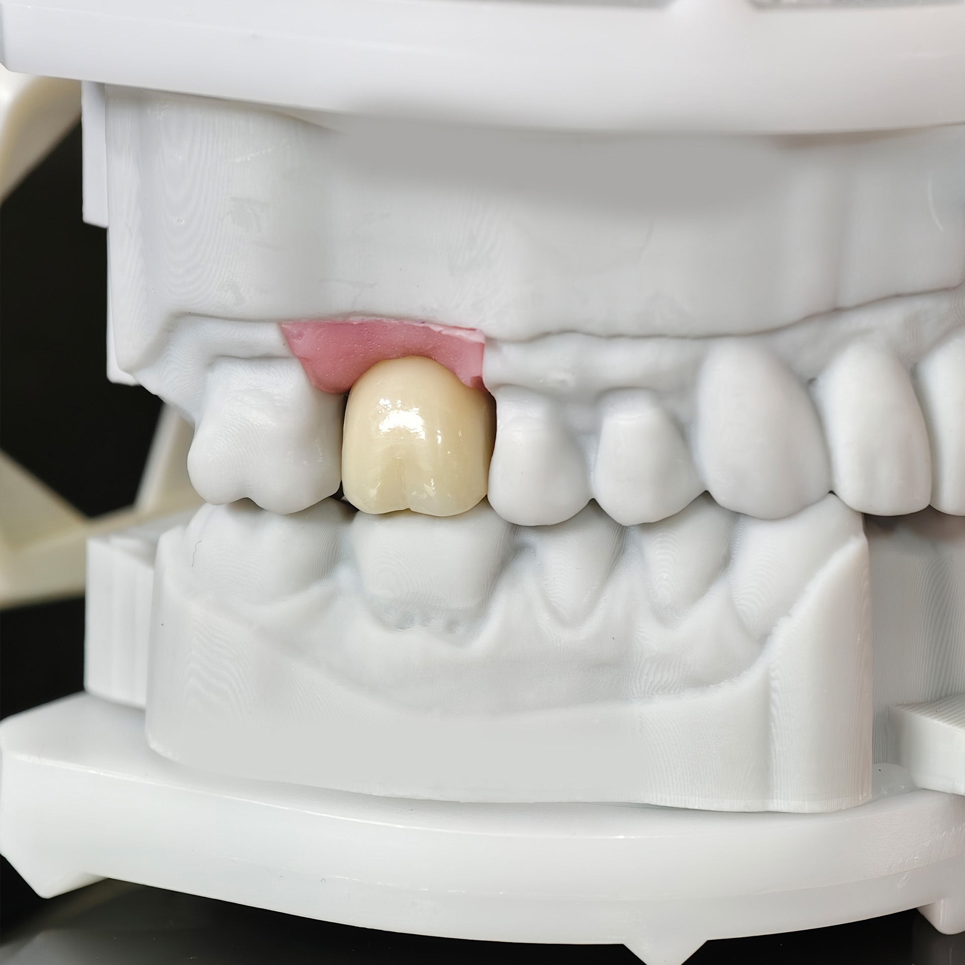 Zirconia Crown With Screw Retained