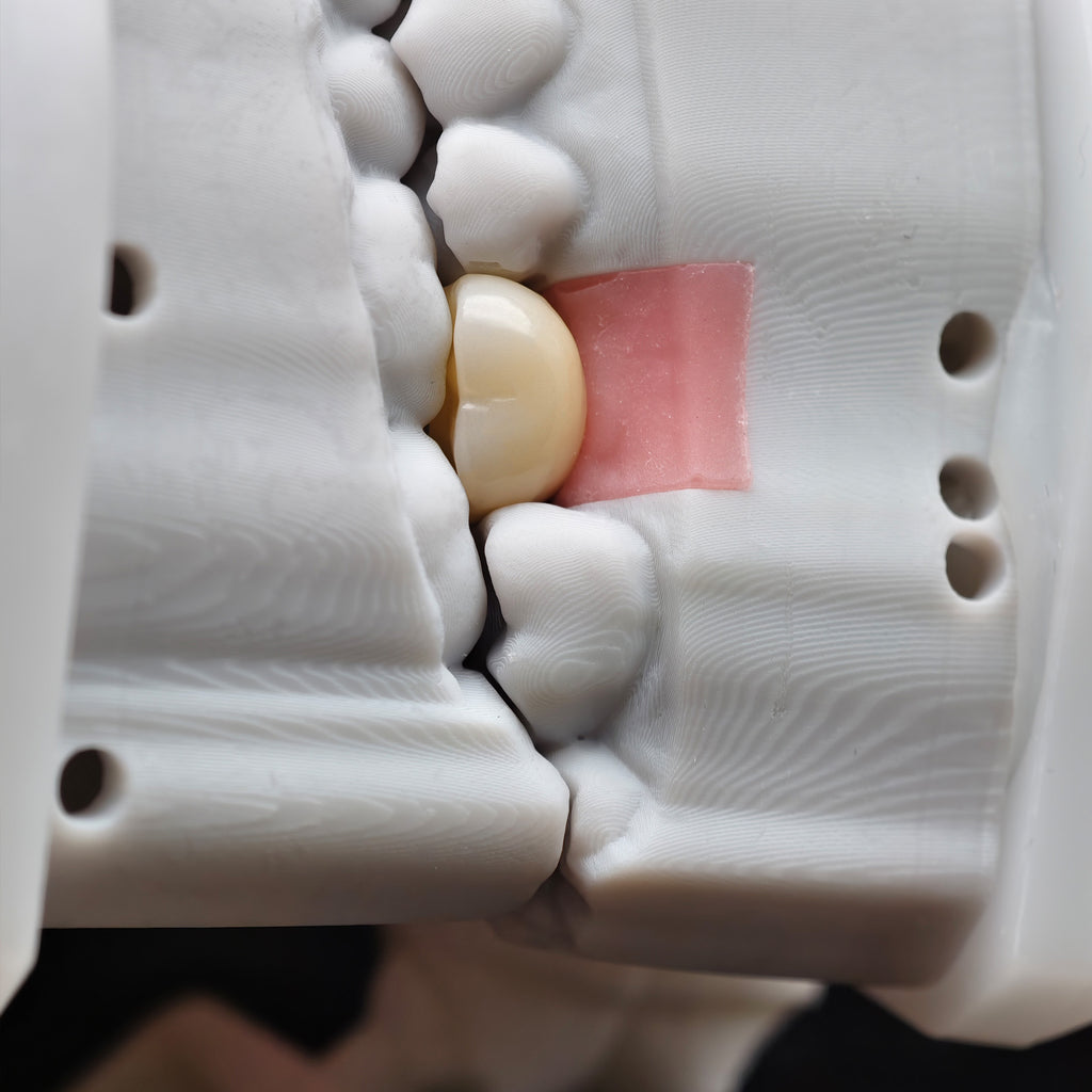 Zirconia Crown With Screw Retained