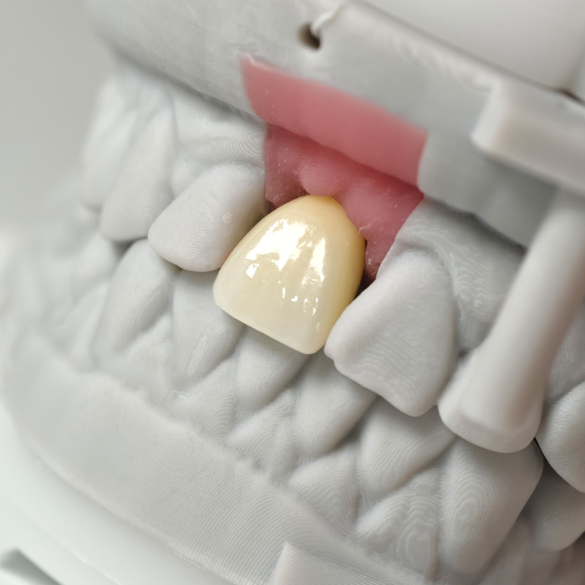 Zirconia Crown With Screw Retained