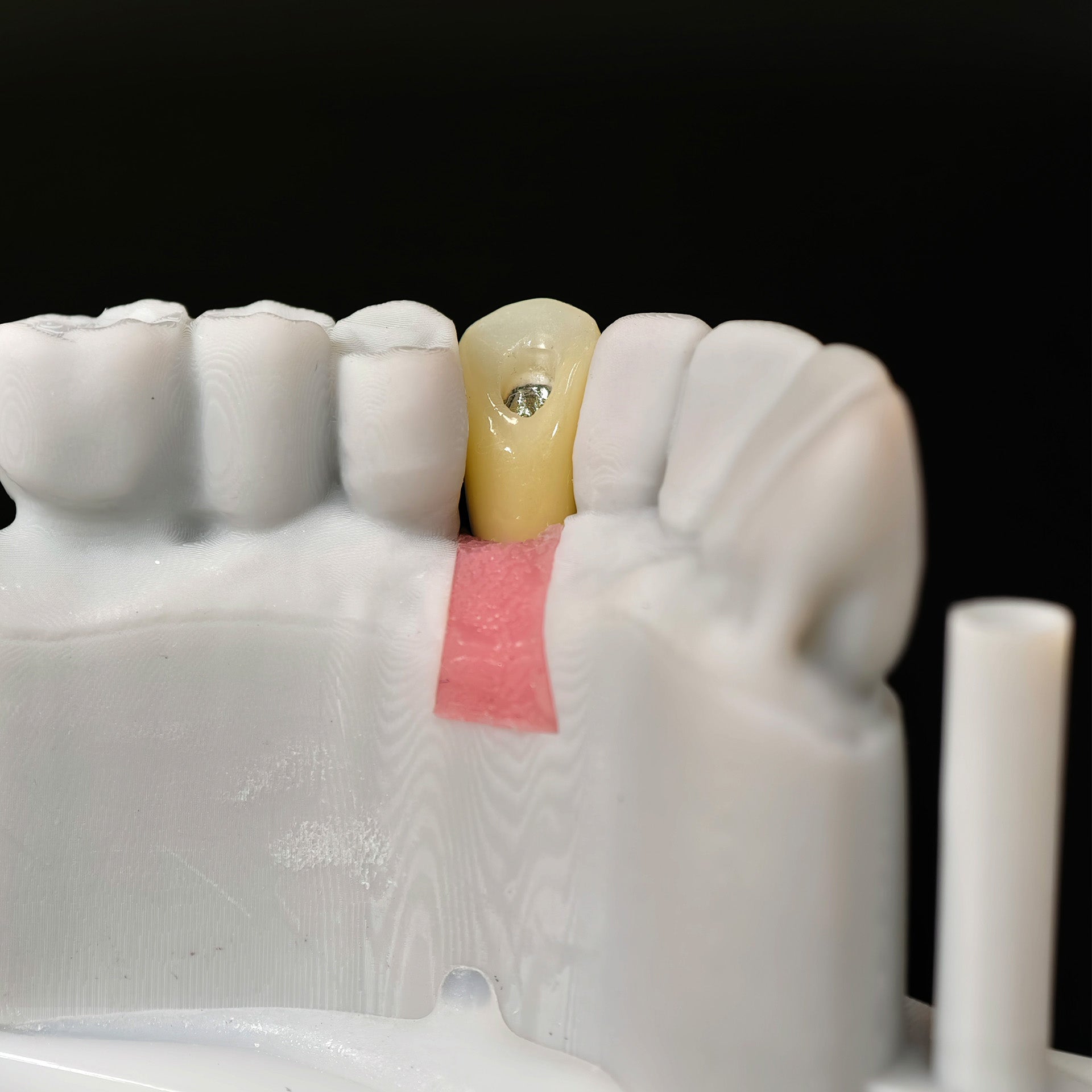 Zirconia Crown With Screw Retained