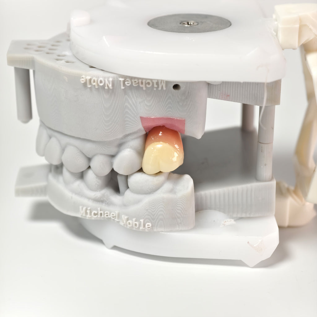 Zirconia Crown With Screw Retained