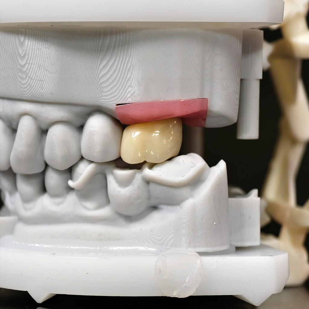 Zirconia Crown With Screw Retained