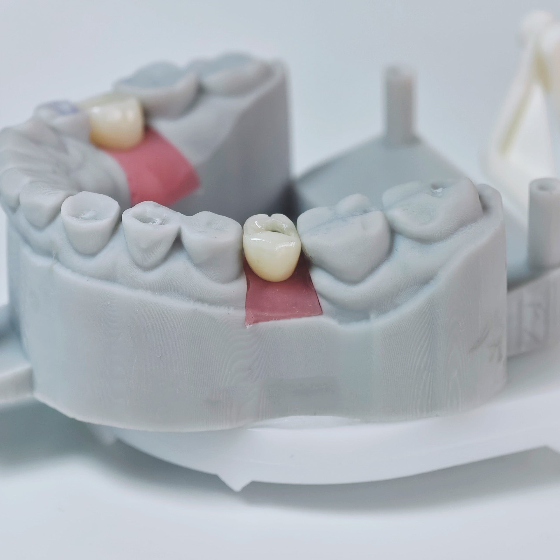 Zirconia Crown With Screw Retained