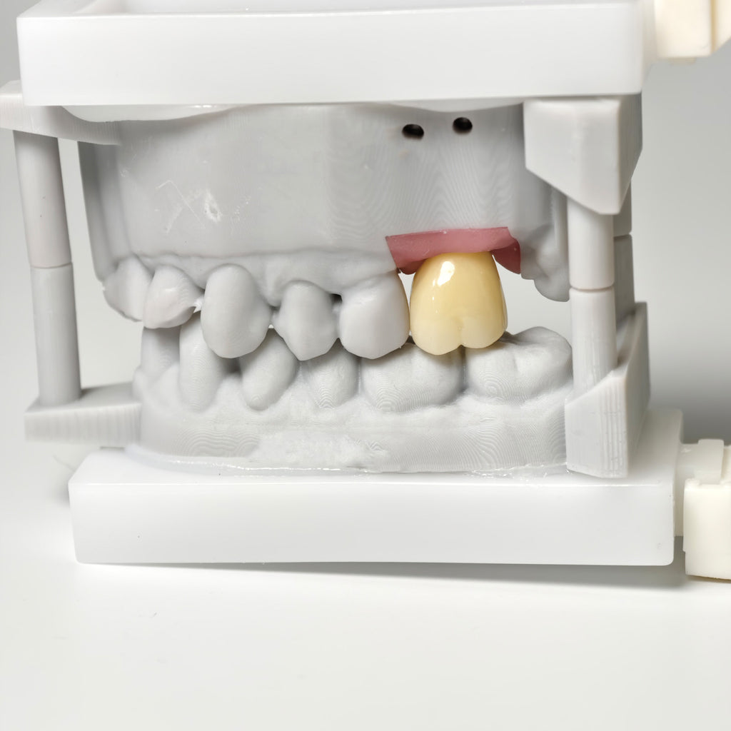 Zirconia Crown With Screw Retained