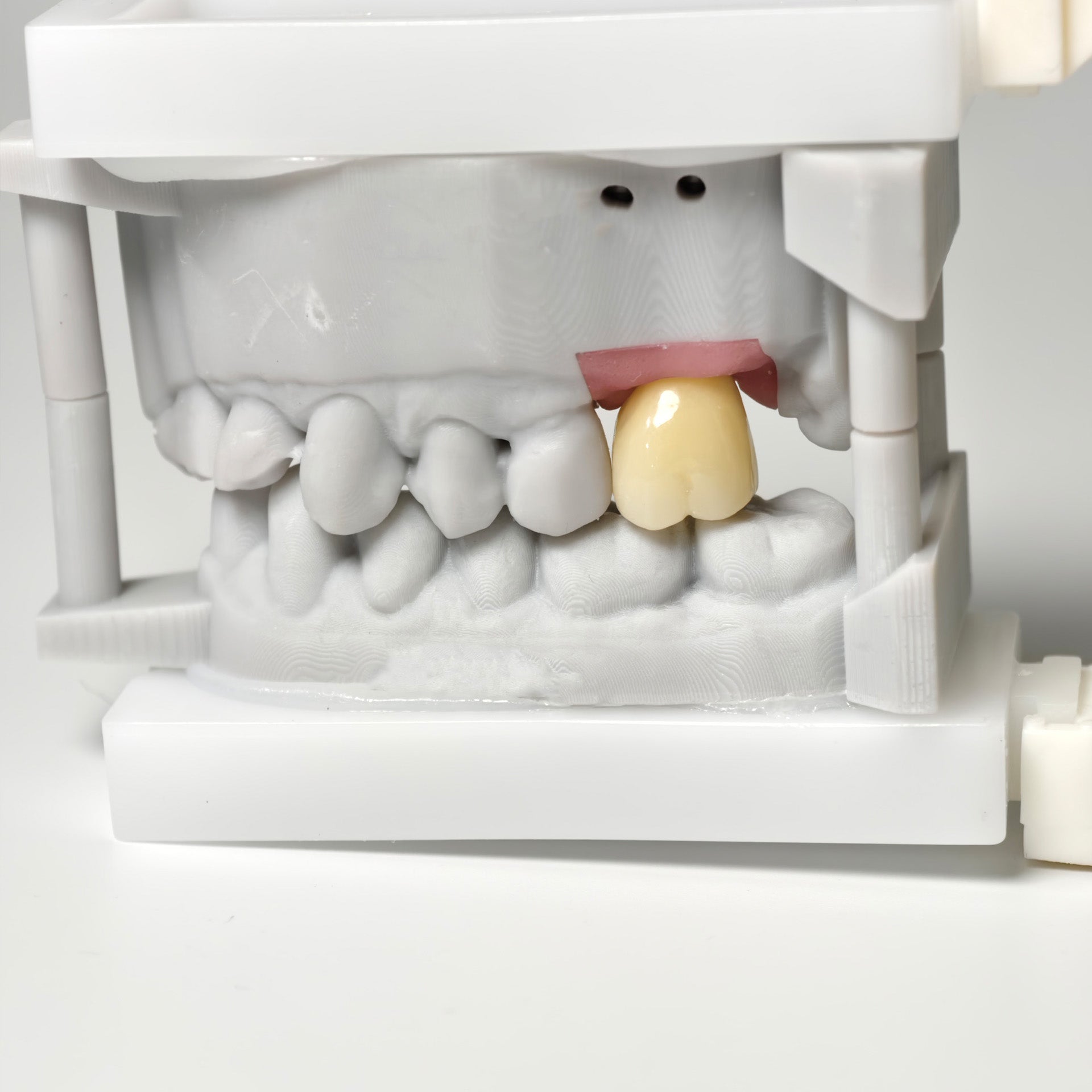 Zirconia Crown With Screw Retained