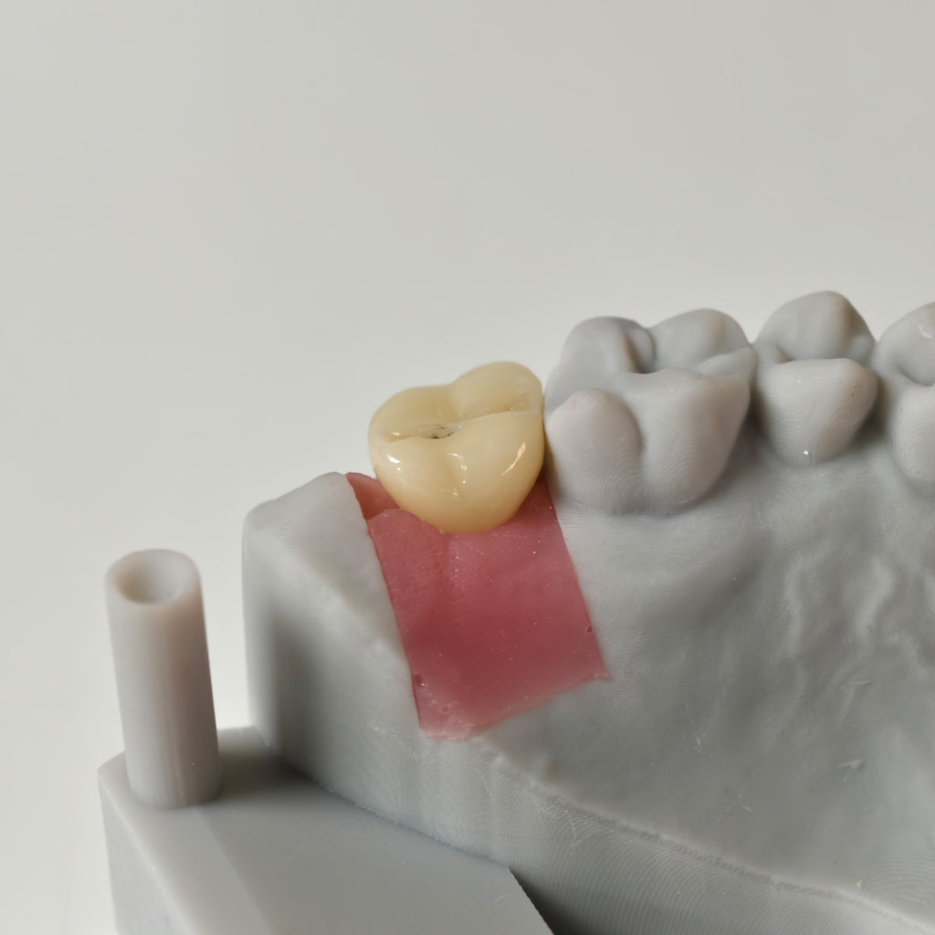 Zirconia Crown With Screw Retained