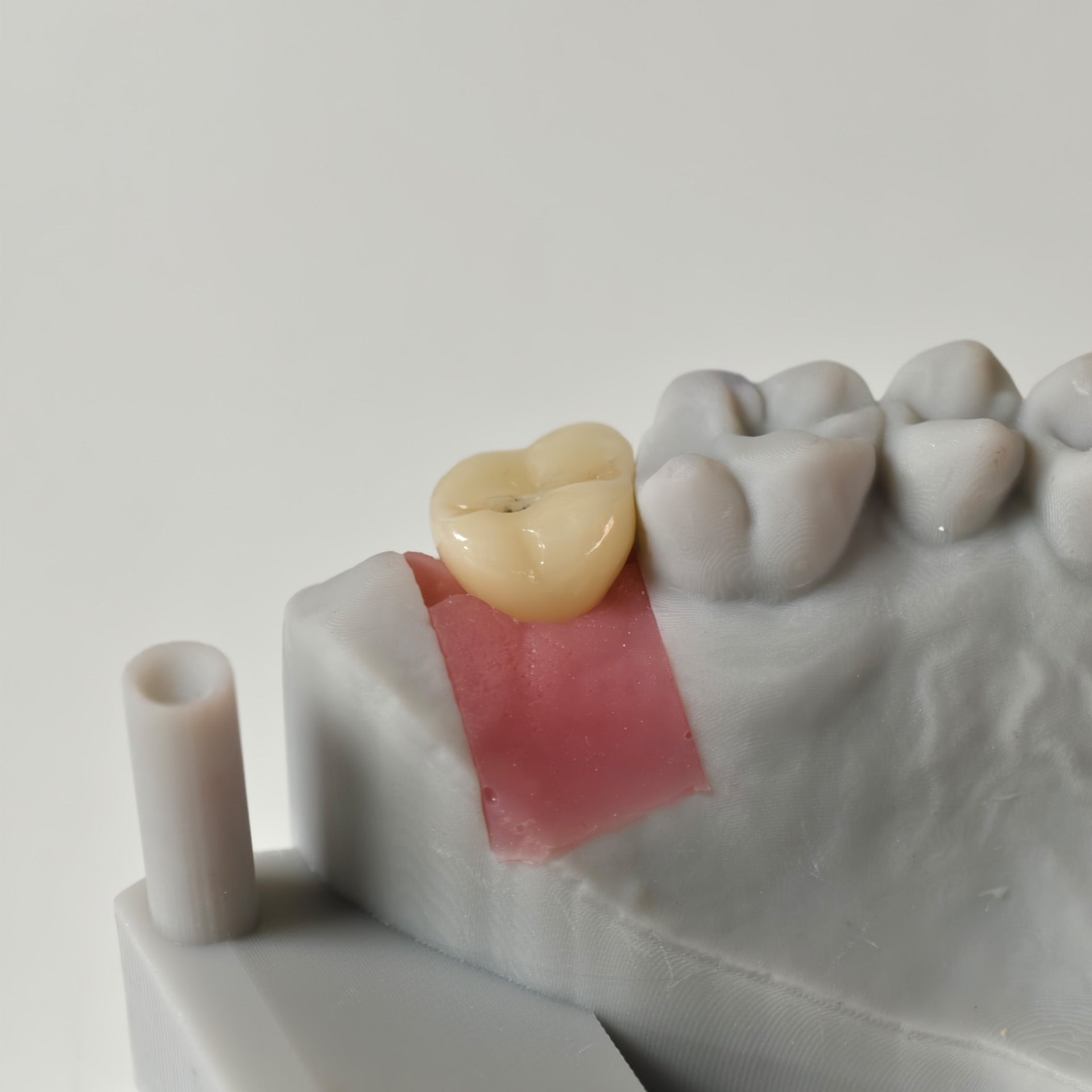 Zirconia Crown With Screw Retained